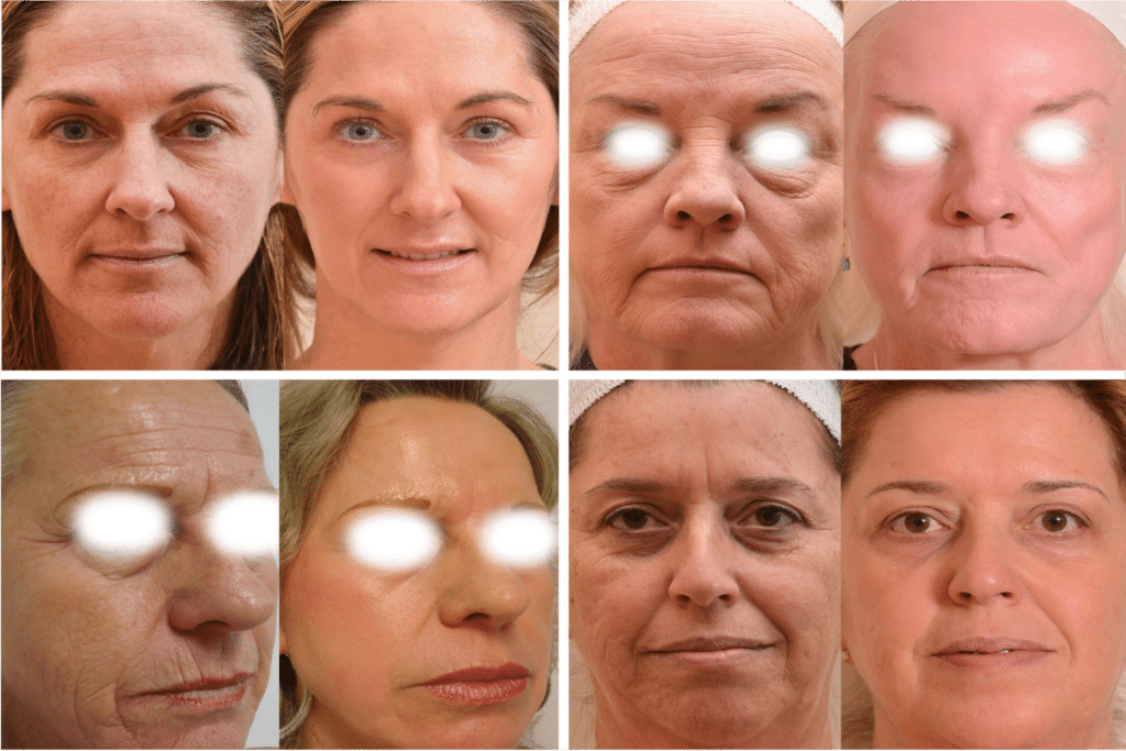 Laser CO2 Avant Après Dermatologue Esthétique Skin Marceau