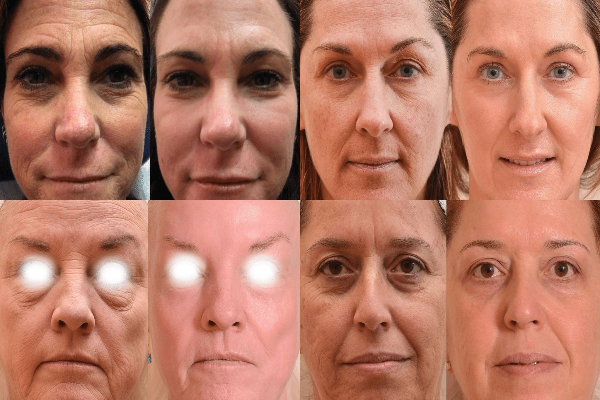 laser resurfacing skin marceau paris