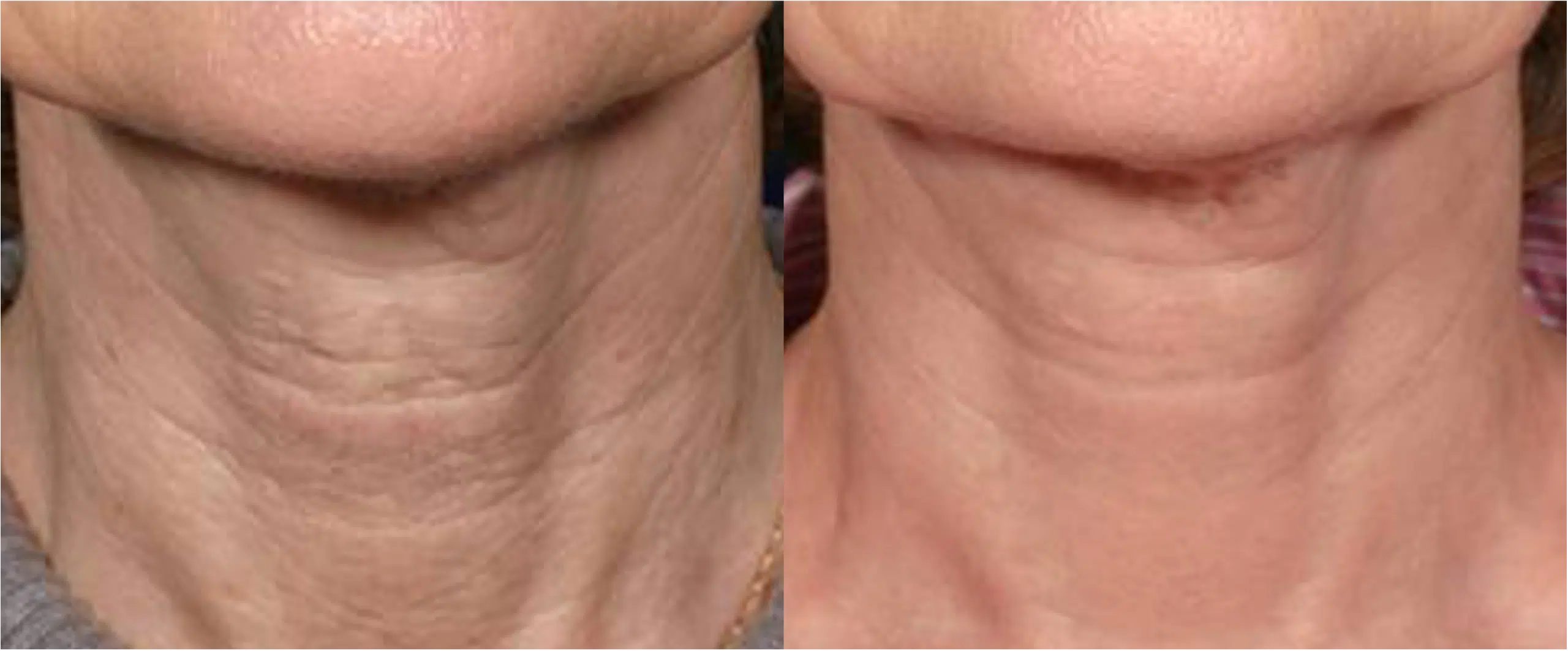 Laser skin resurfacing CO2 fully ablative Ultrapulse