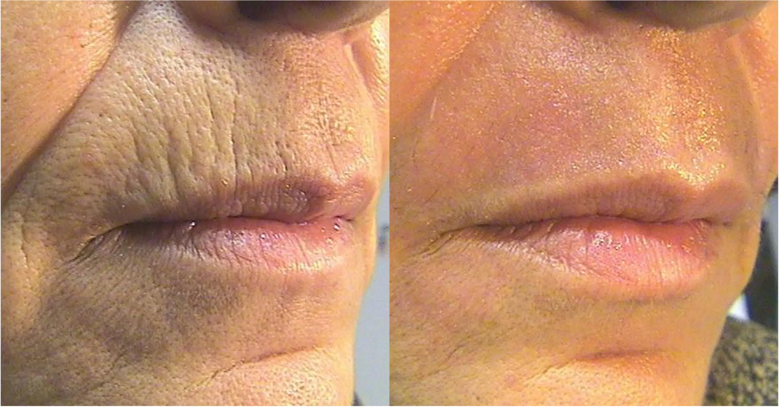 Laser skin resurfacing CO2 fully ablative Ultrapulse
