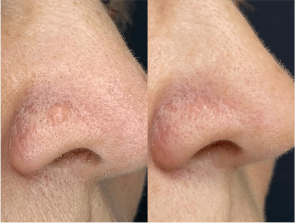 Papule Fibreuse du Nez : Traitement, Photos et Laser