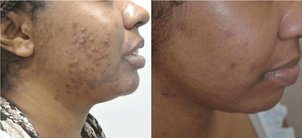 marques post-acné Hyperpigmentation post-inflammatoire