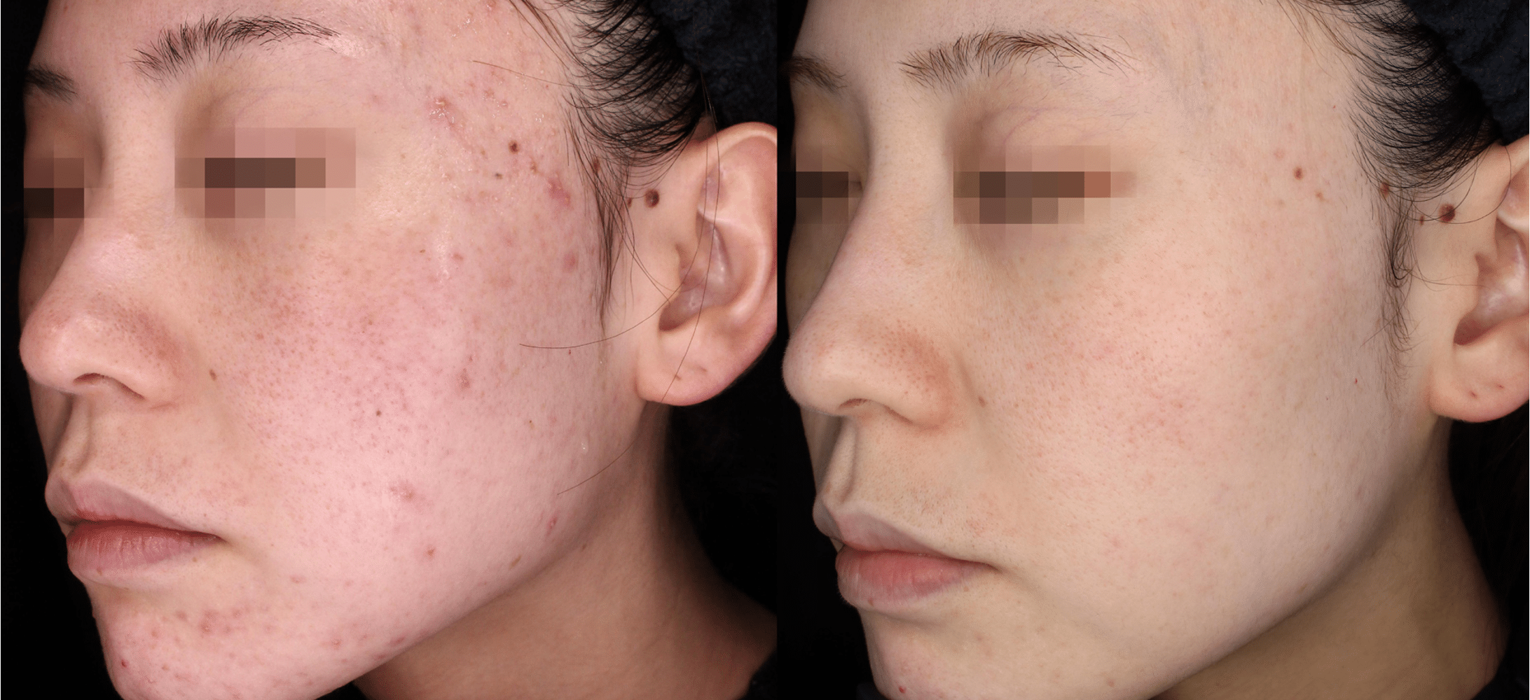 marques post-acné Hyperpigmentation post-inflammatoire