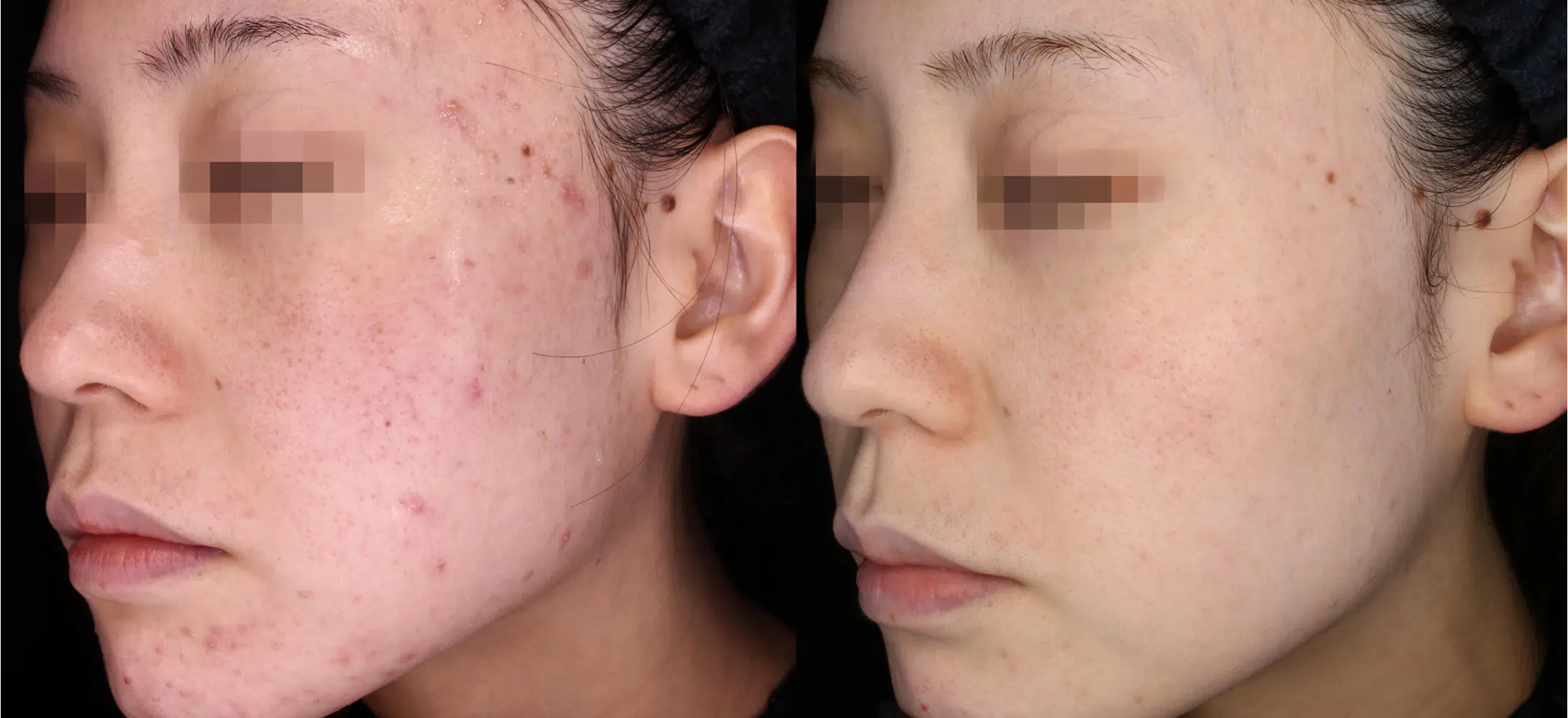 marques post-acné Hyperpigmentation post-inflammatoire
