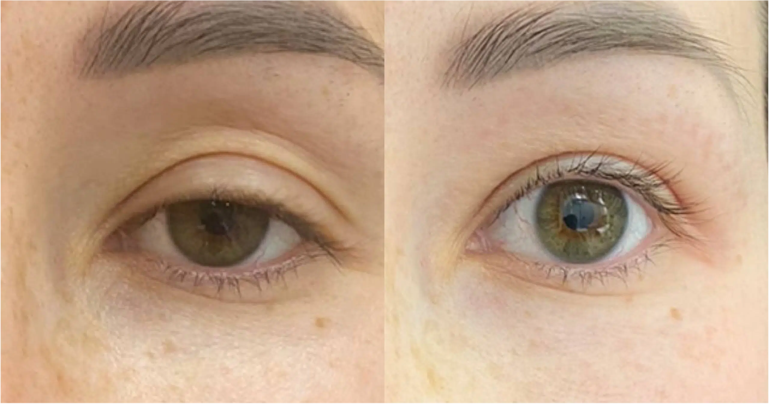 Blépharoplastie laser avant après Ultrapulse Skin Marceau