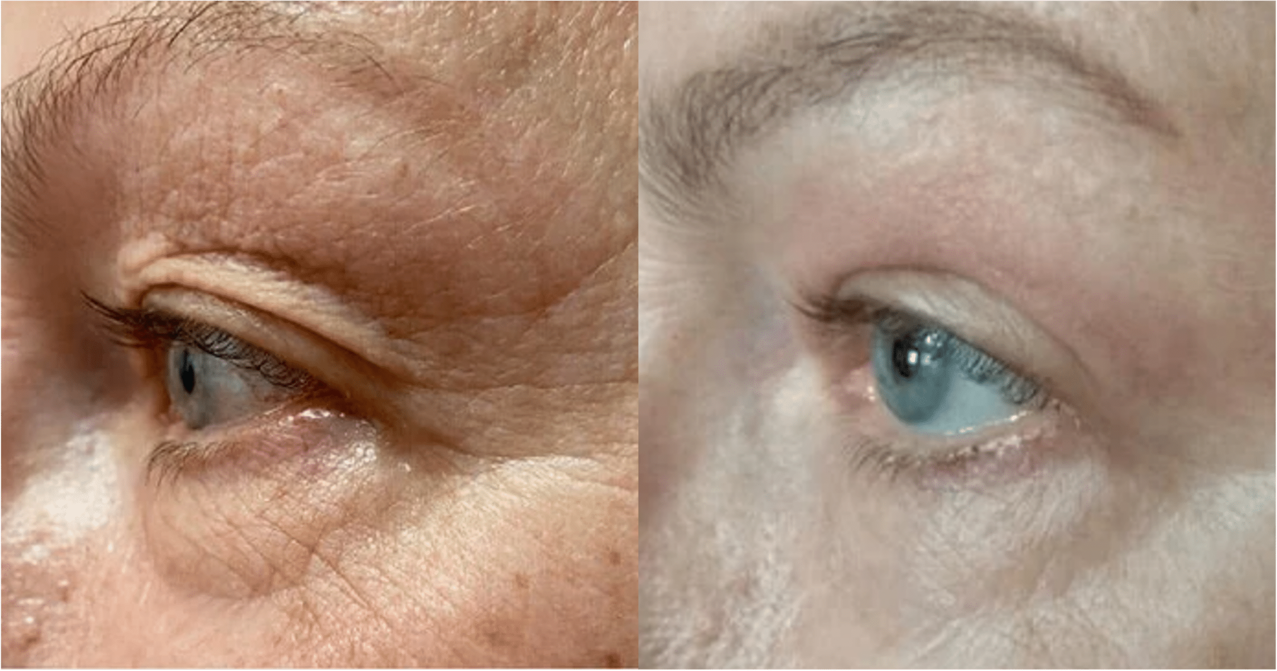 Blépharoplastie laser avant après Ultrapulse Skin Marceau