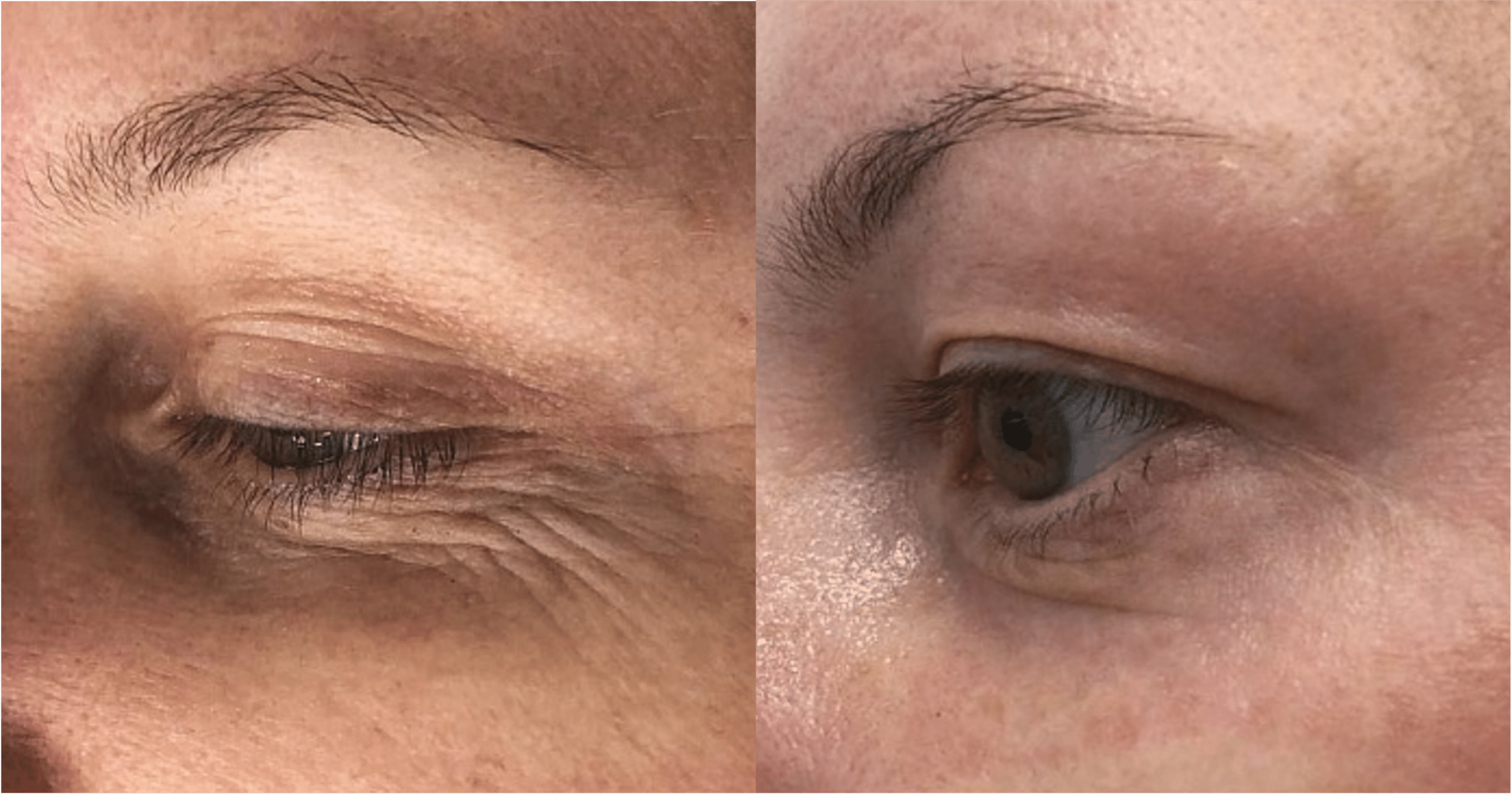 Blépharoplastie laser avant après Ultrapulse Skin Marceau