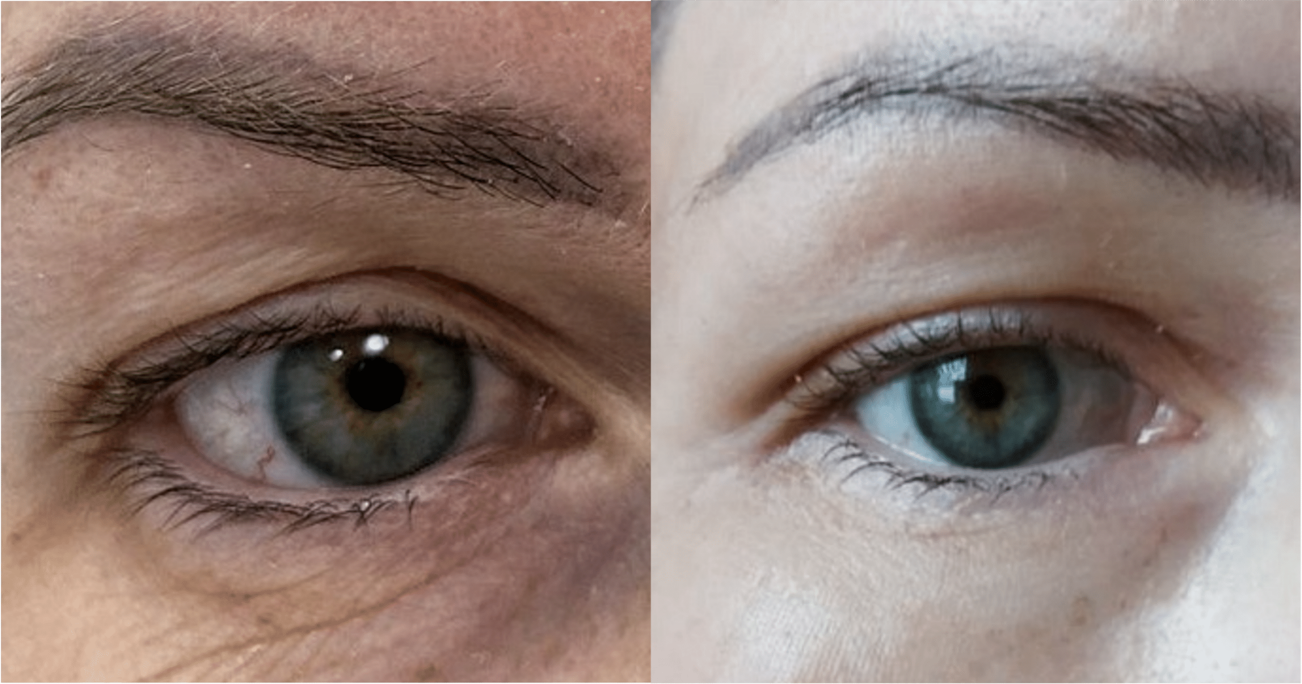 Blépharoplastie laser avant après Ultrapulse Skin Marceau