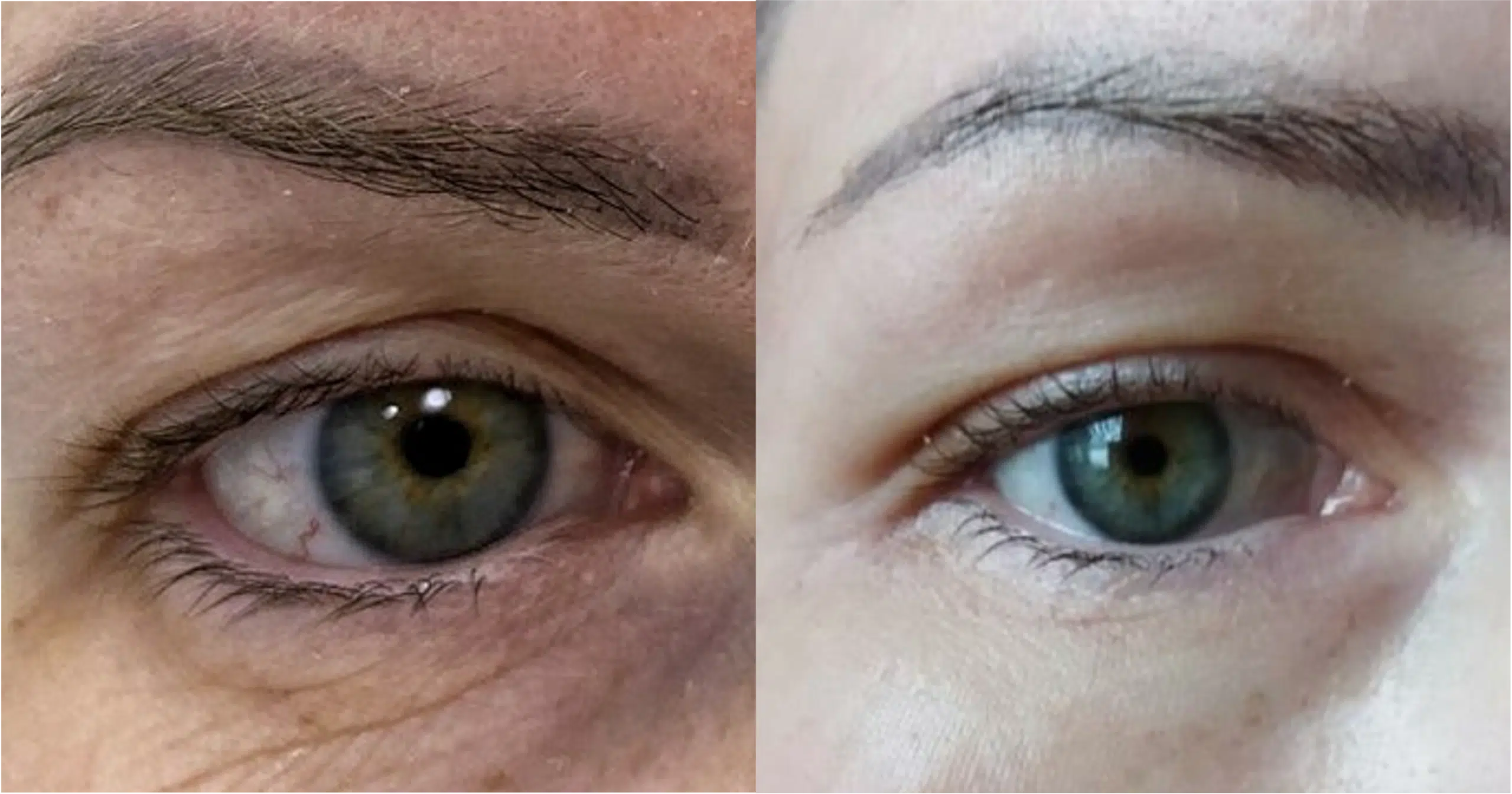 Blépharoplastie laser avant après Ultrapulse Skin Marceau
