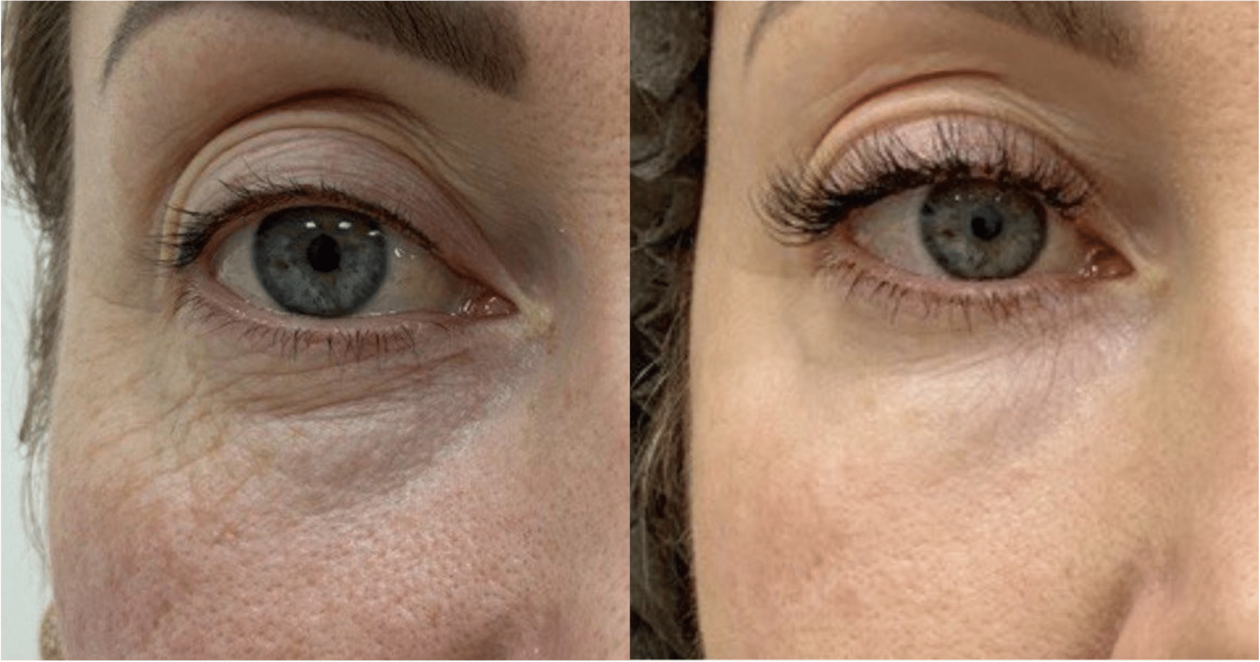 Blépharoplastie laser avant après Ultrapulse Skin Marceau