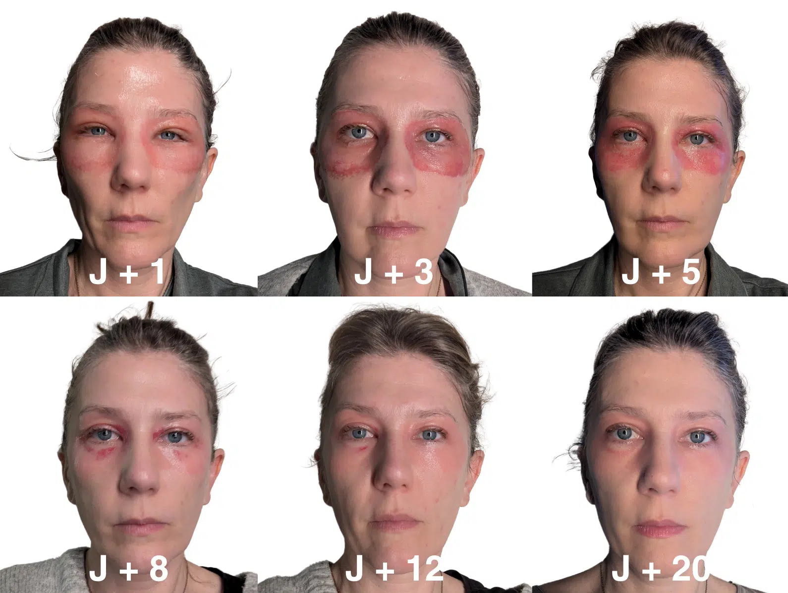 blepharoplastie medicale jour par jour cicatrices