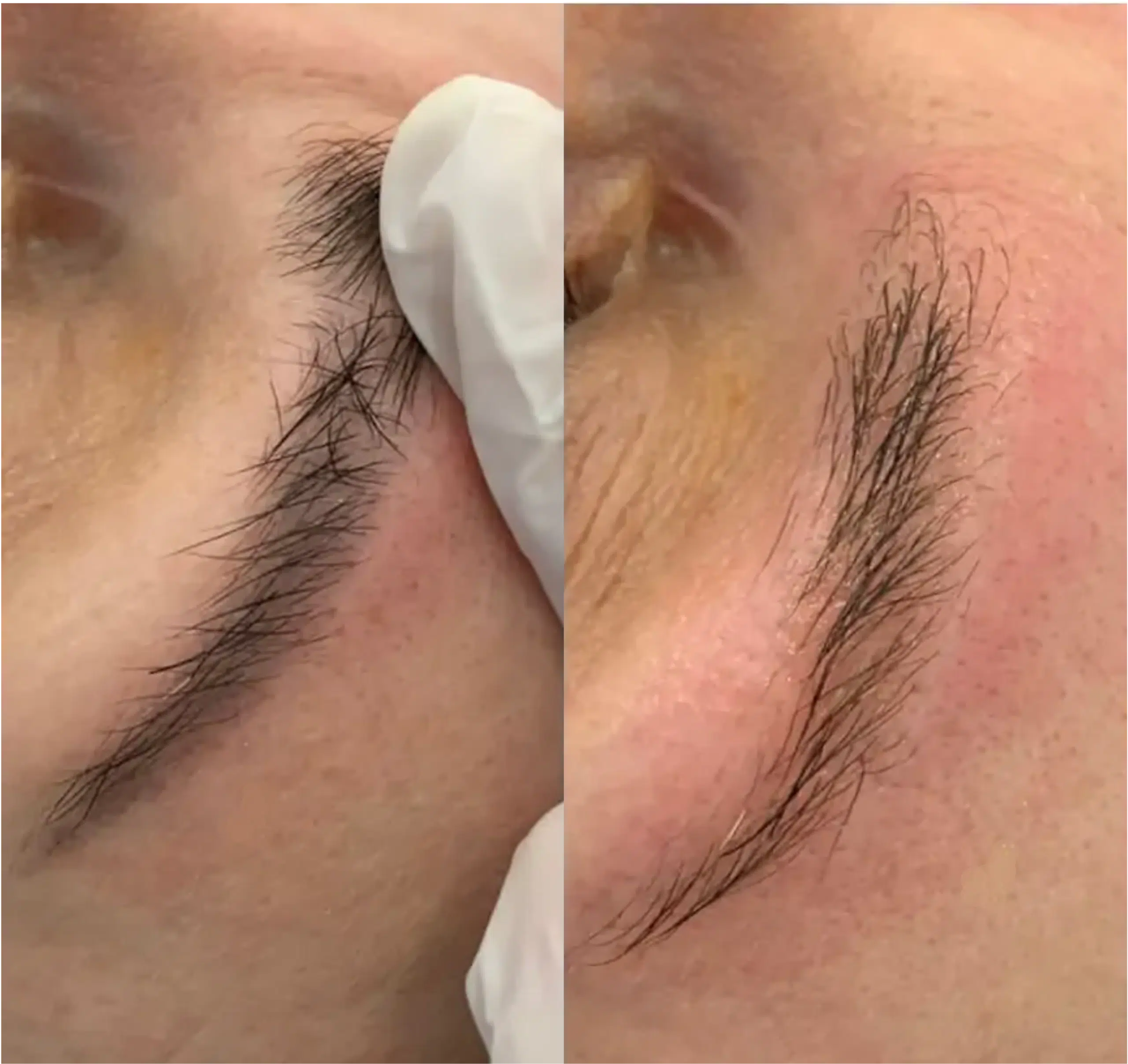 détatouage sourcils avant après laser paris