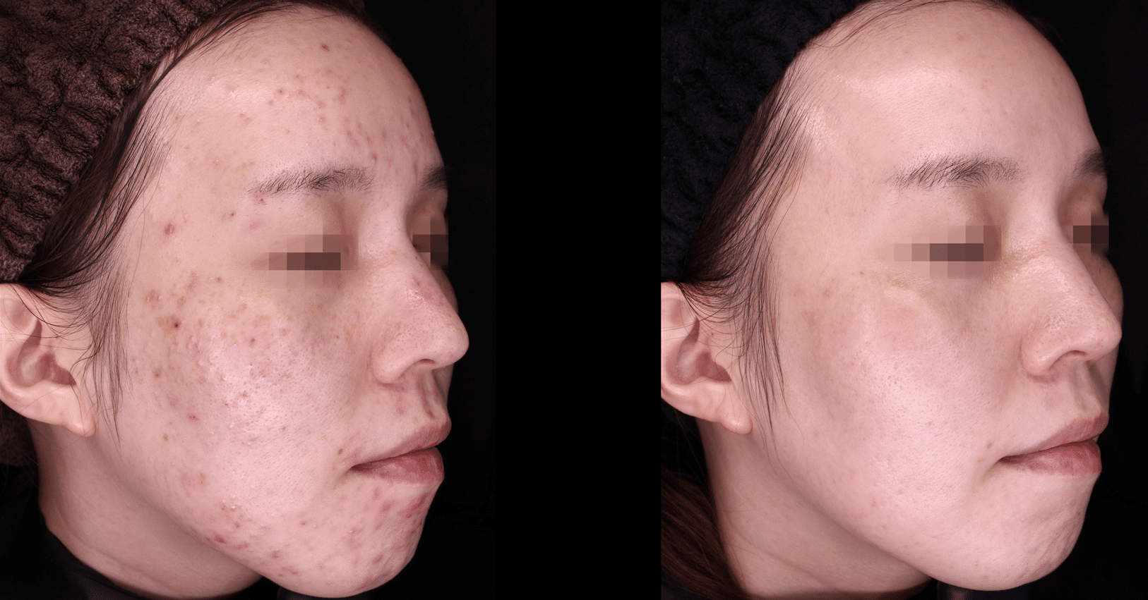 hyperpigmentation post inflammatoire traitement picosure pro 3 seance