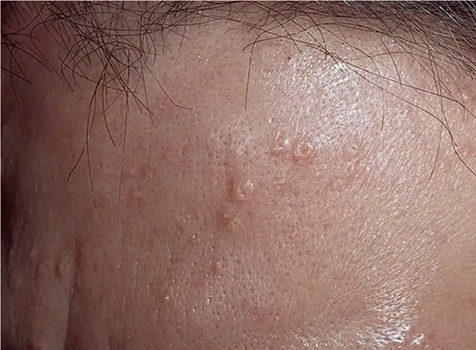 hyperplasie sebacée photo traitement laser paris