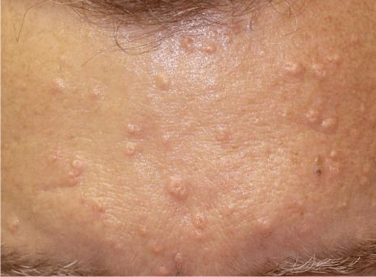 Veruci Sebacee Hyperplasie Sébacée : Causes, Photos et Traitement au Laser