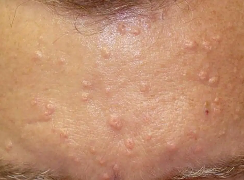 hyperplasie sebacée photo traitement laser paris