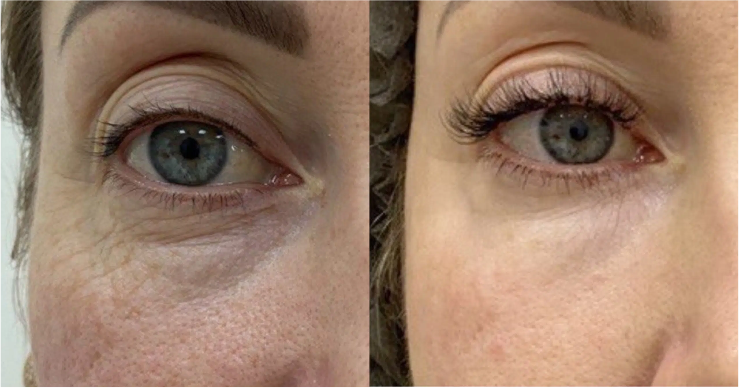 laser eyelid CO2 Paris Skin Marceau tightening Ultrapulse