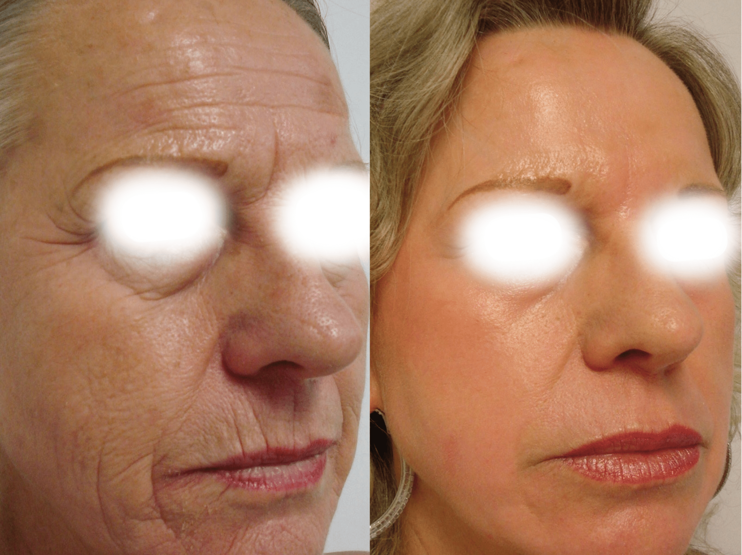 laser resurfacing resurfacage Paris Skin Marceau ablatif complet 4