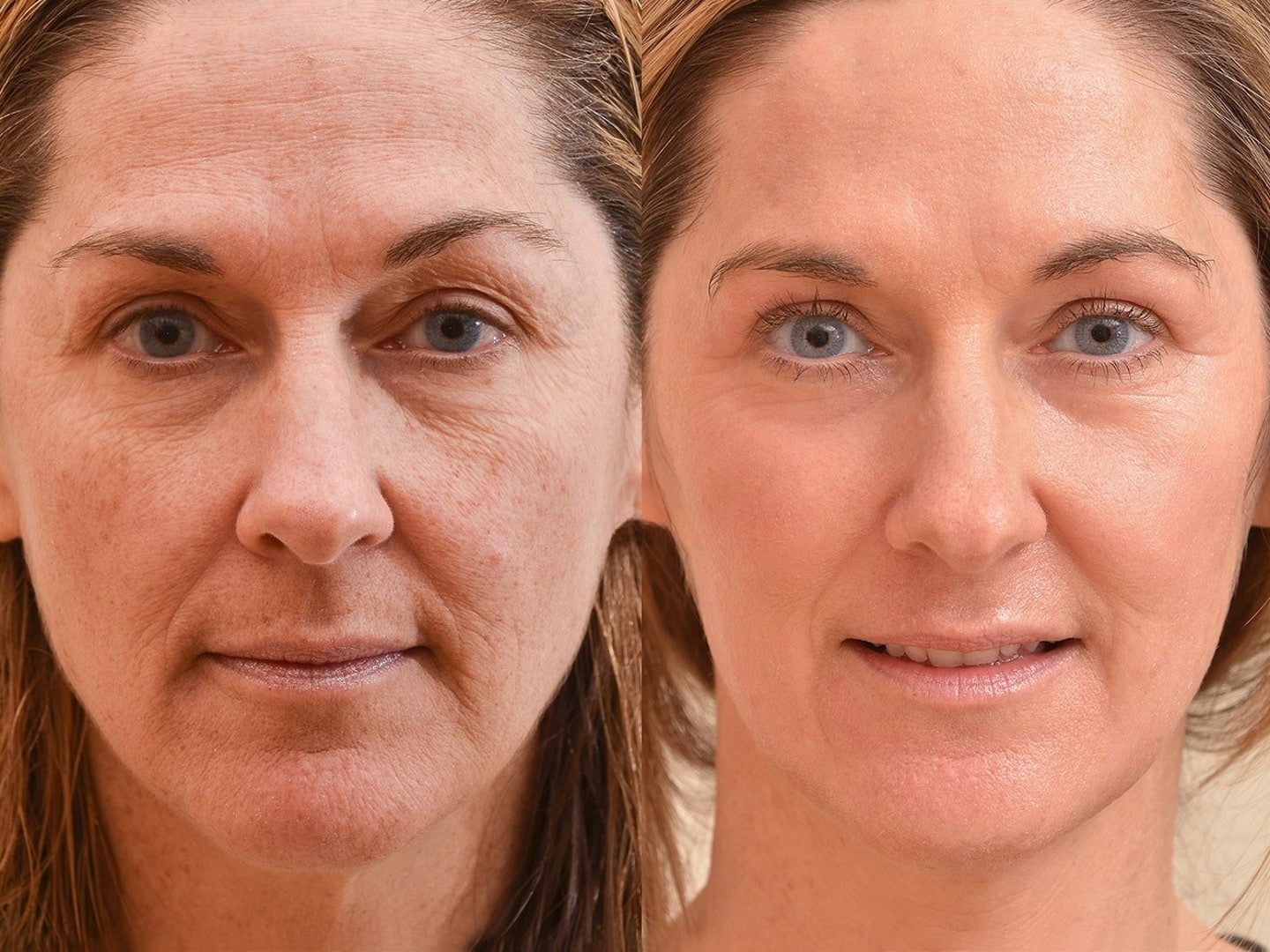 laser resurfacing resurfacage Paris Skin Marceau ablatif complet 5