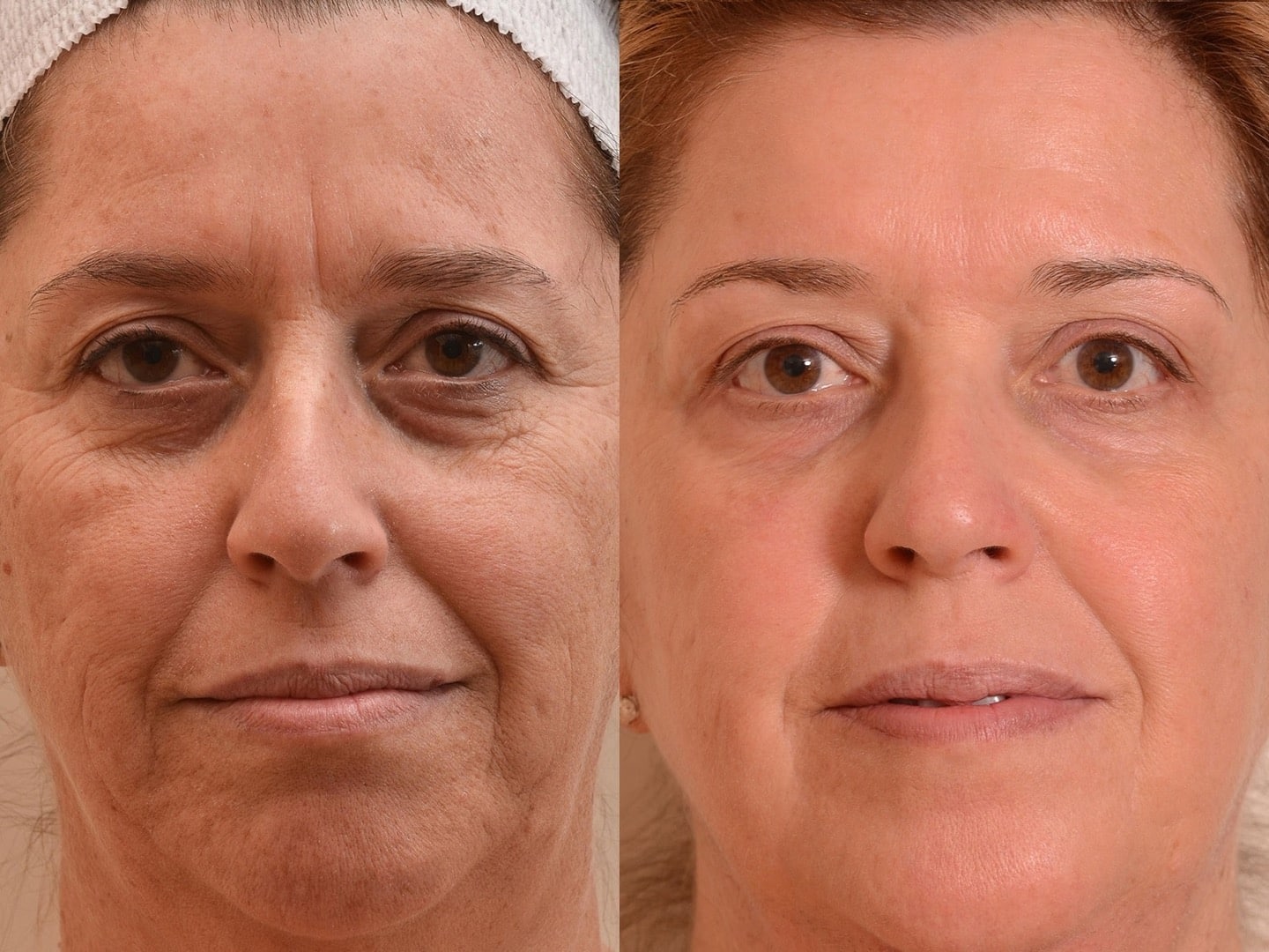 laser resurfacing resurfacage Paris Skin Marceau ablatif complet 6