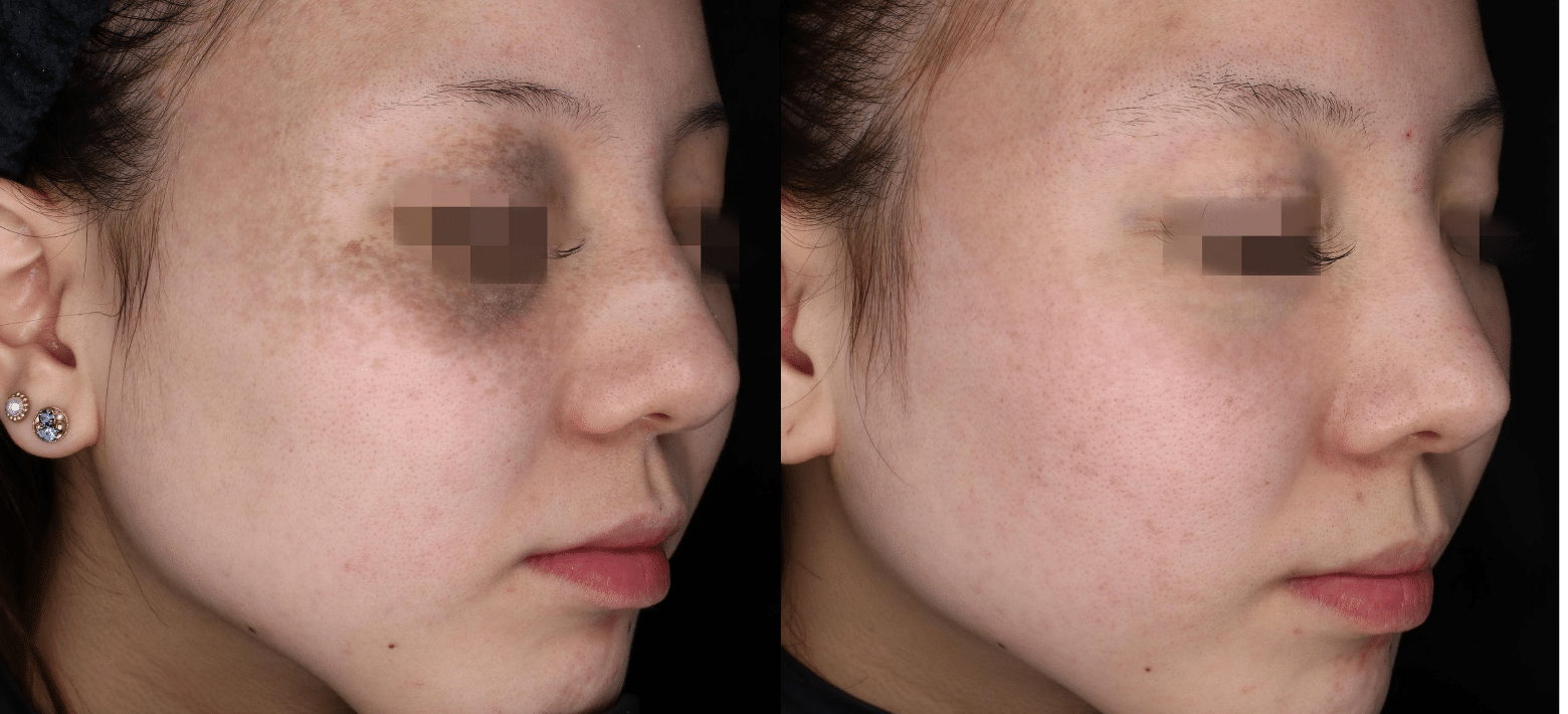 melasma