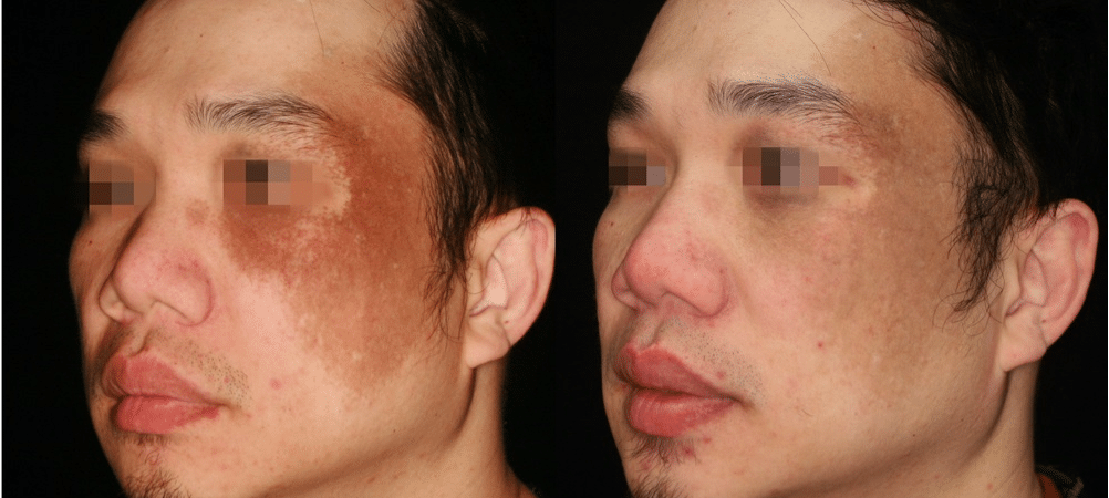 melasma traitement