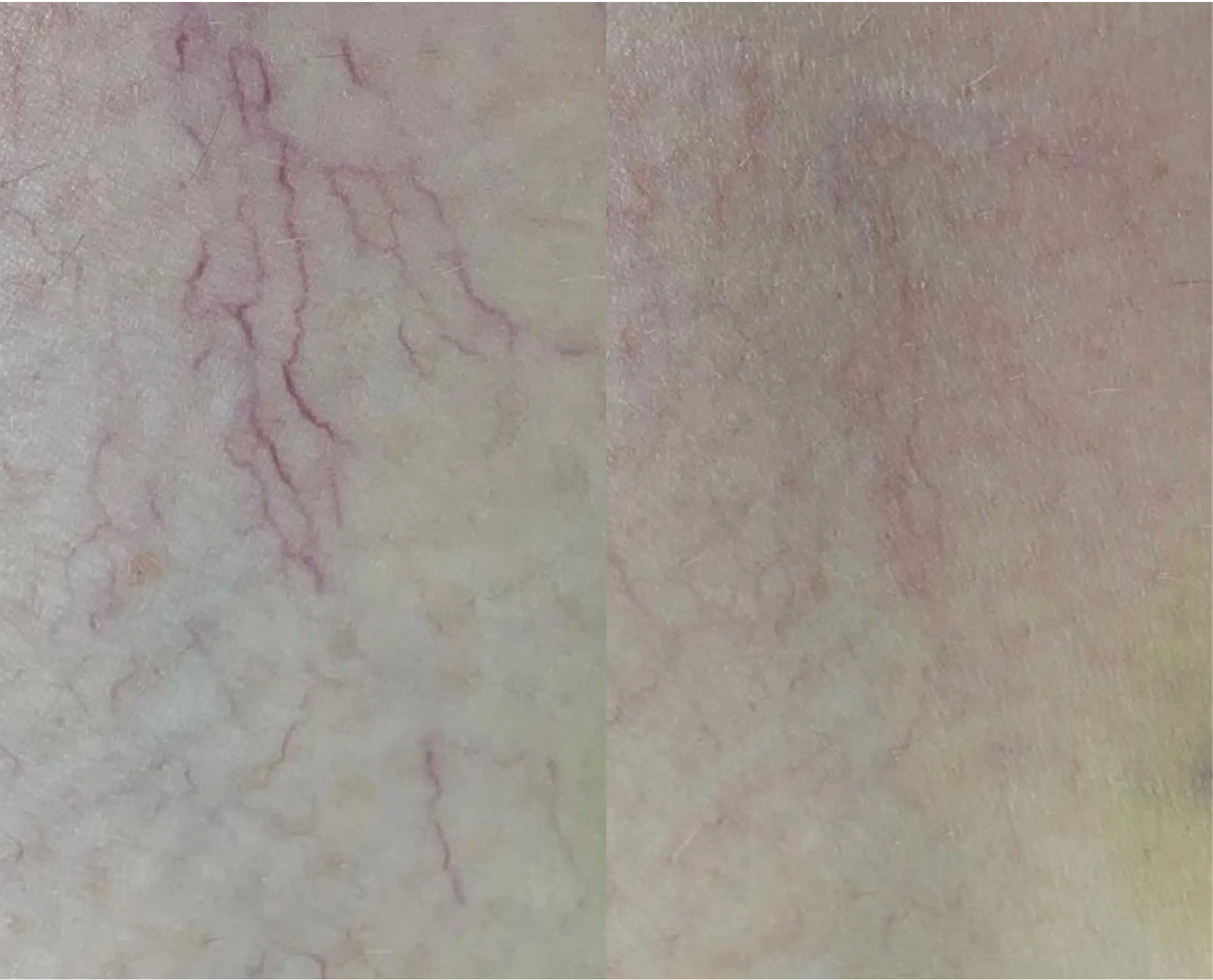 varicosités jambes photo laser traitement 1064 avant apres skin marceau paris