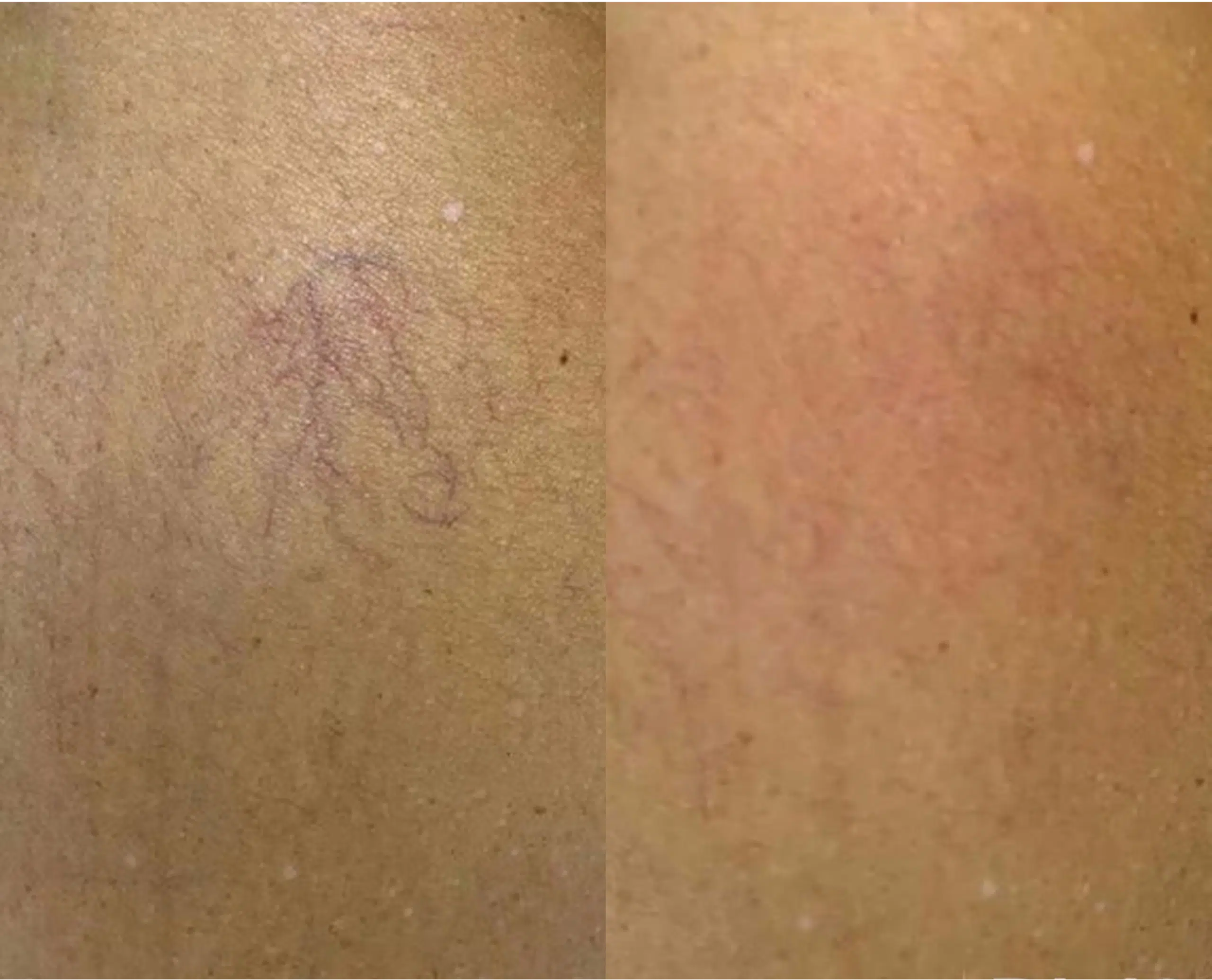 varicosités jambes photo laser traitement 1064 avant apres skin marceau paris