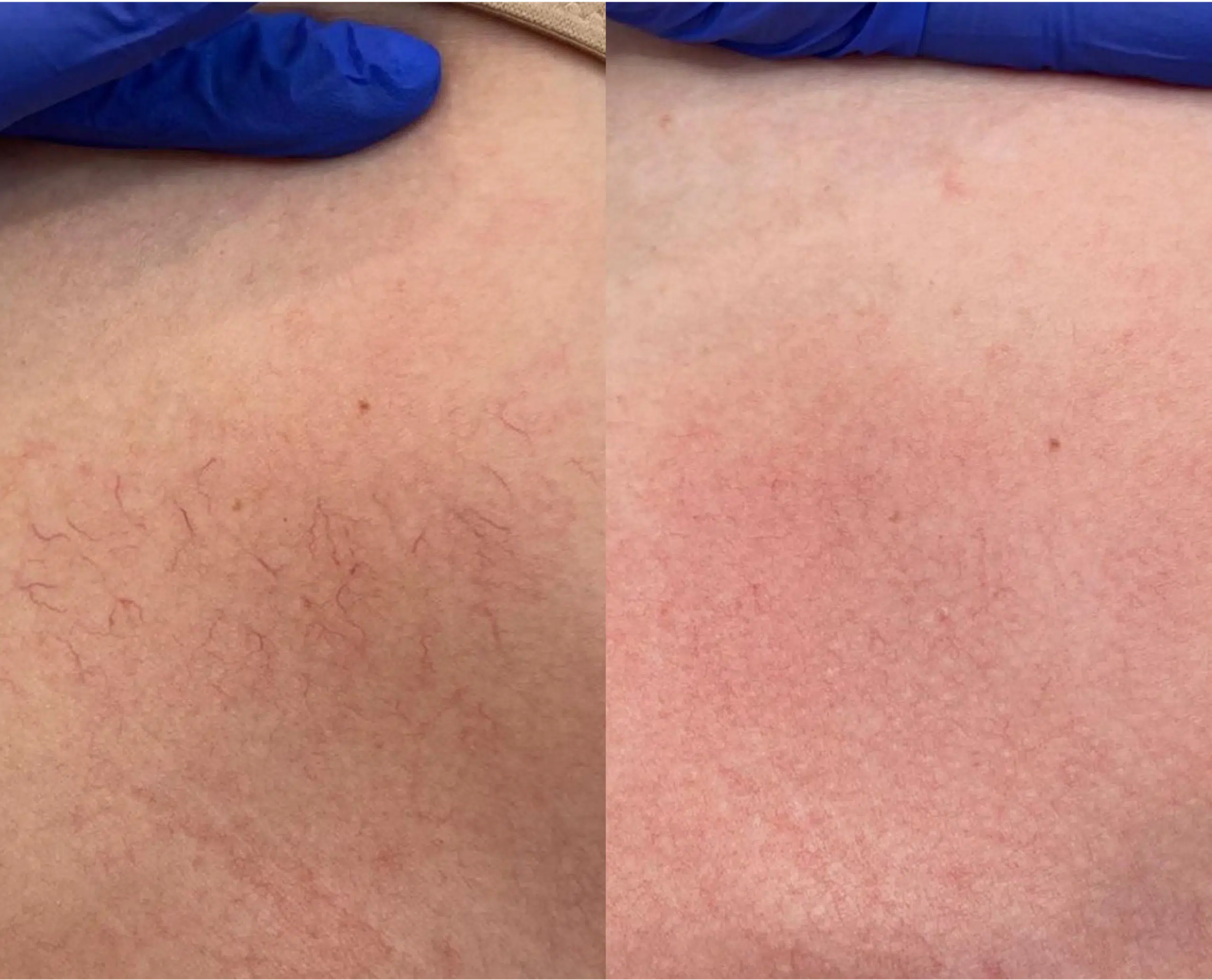 varicosités cuisses photo laser traitement 1064 avant apres skin marceau paris