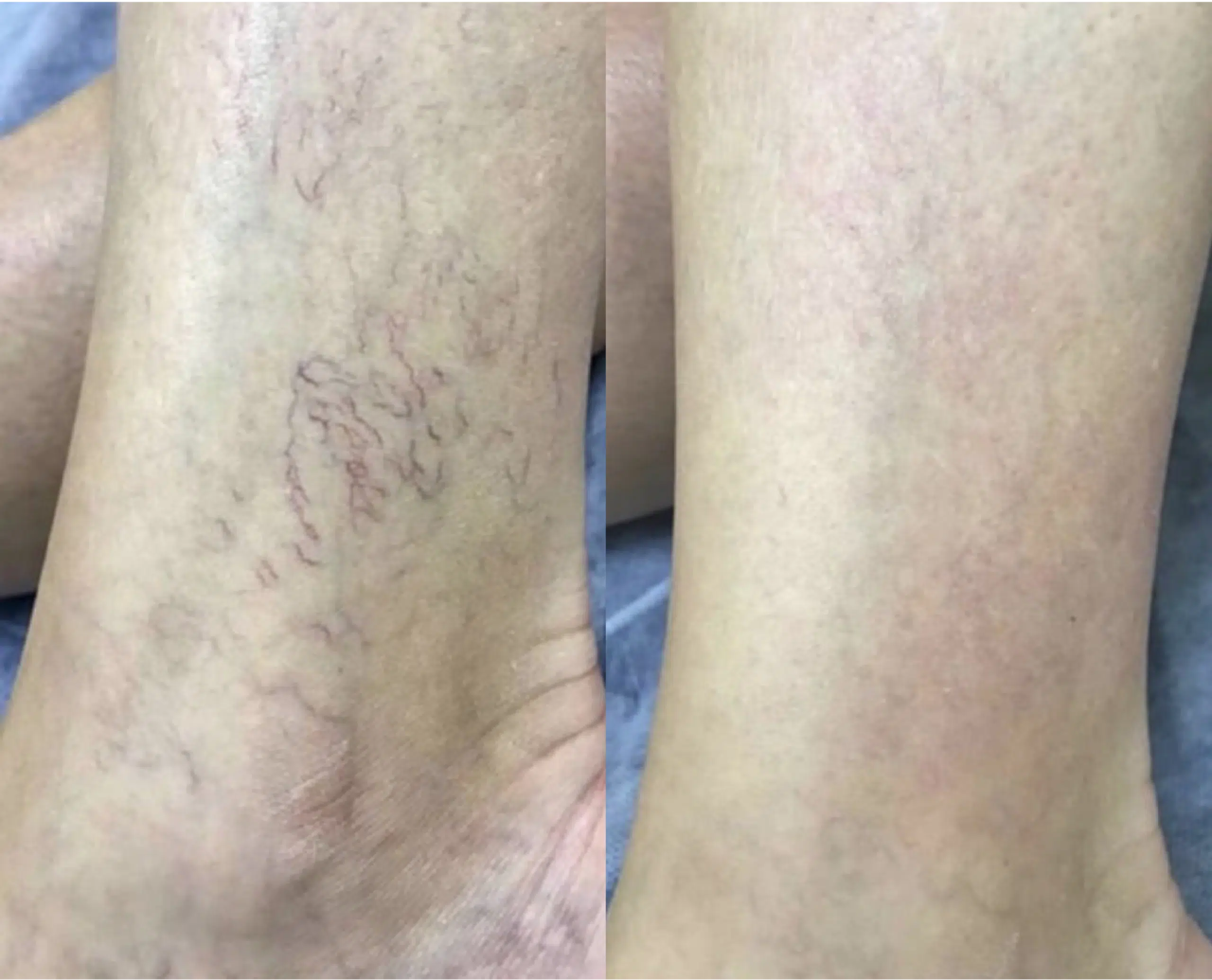varicosités jambes photo laser traitement 1064 avant apres skin marceau paris