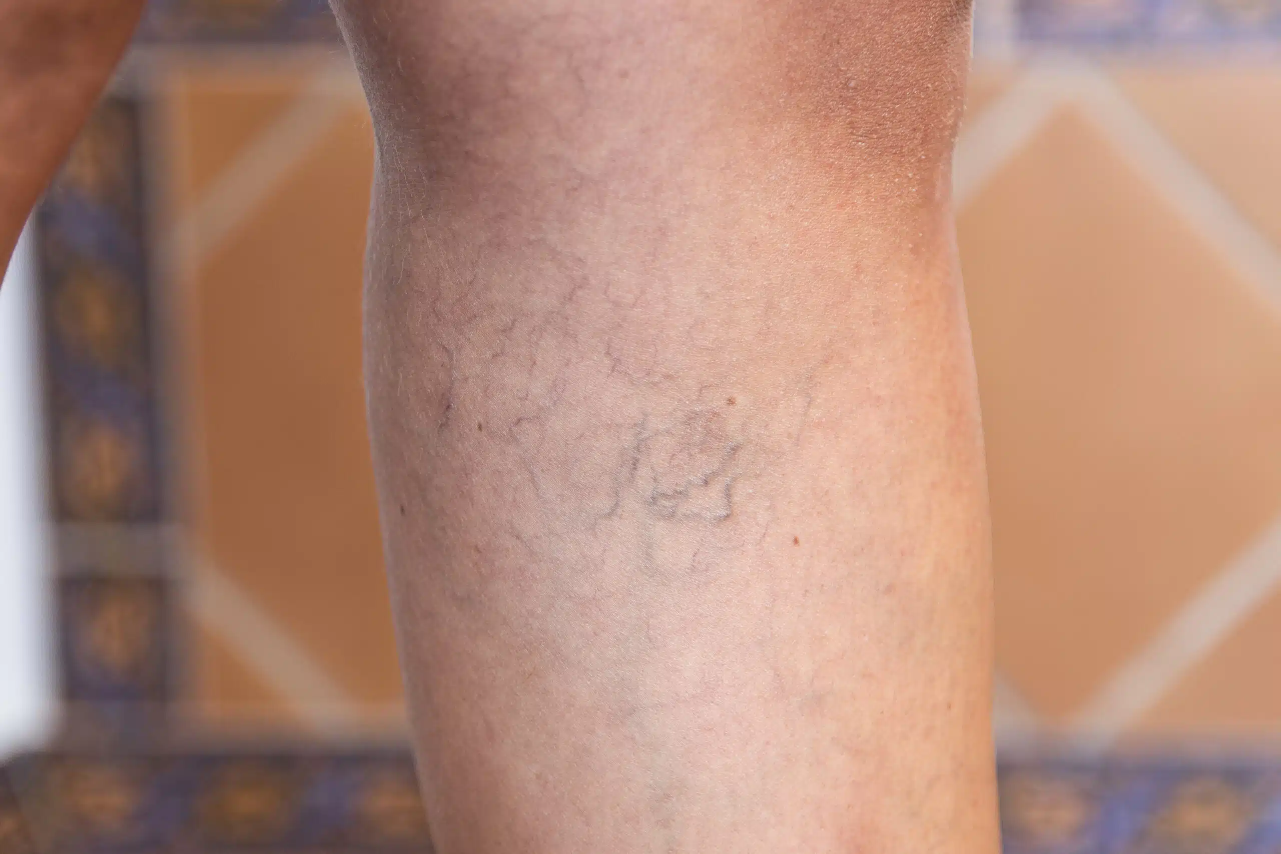 varicosités jambes photos