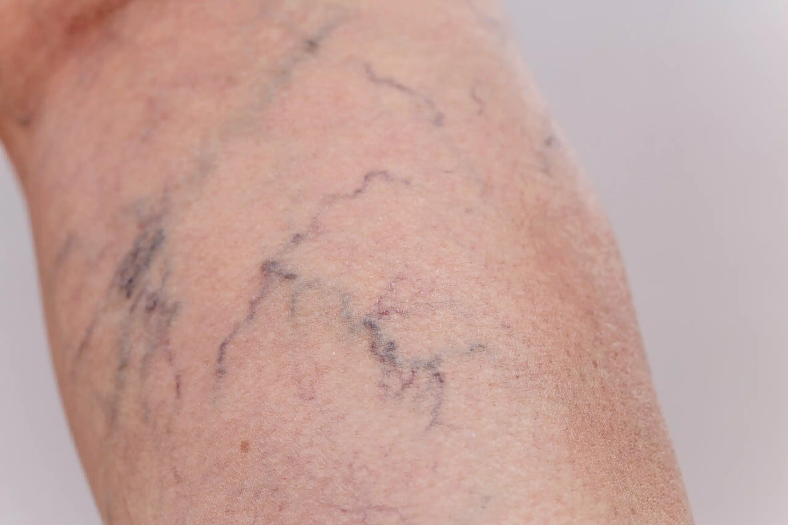 varicosités jambes photos