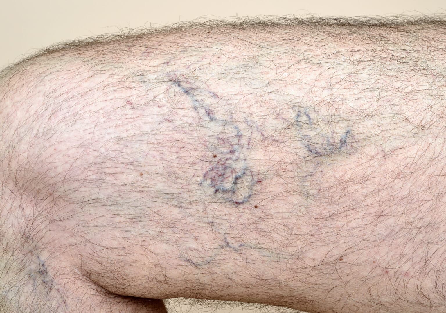 Varicosit s Des Jambes Photos Avant Apr s Et Traitement Au Laser