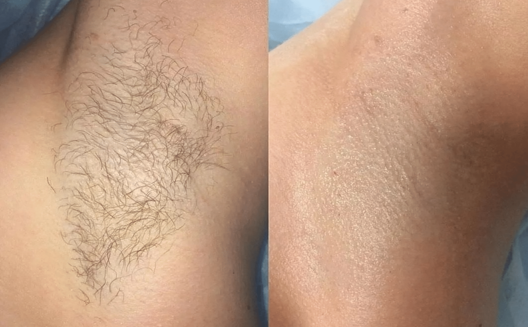 laser-hair-removal-paris-before-after