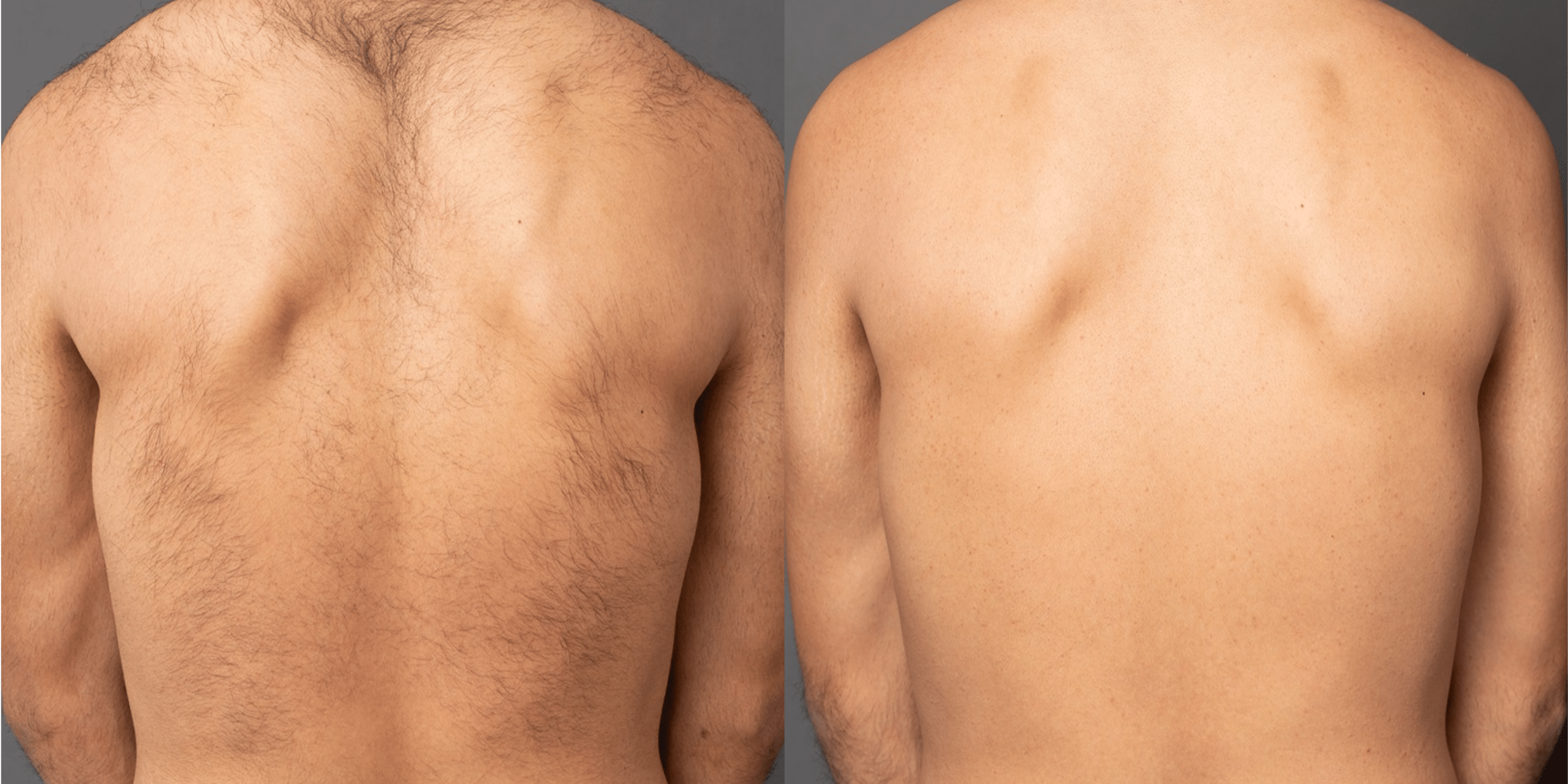 laser-hair-removal-paris-before-after