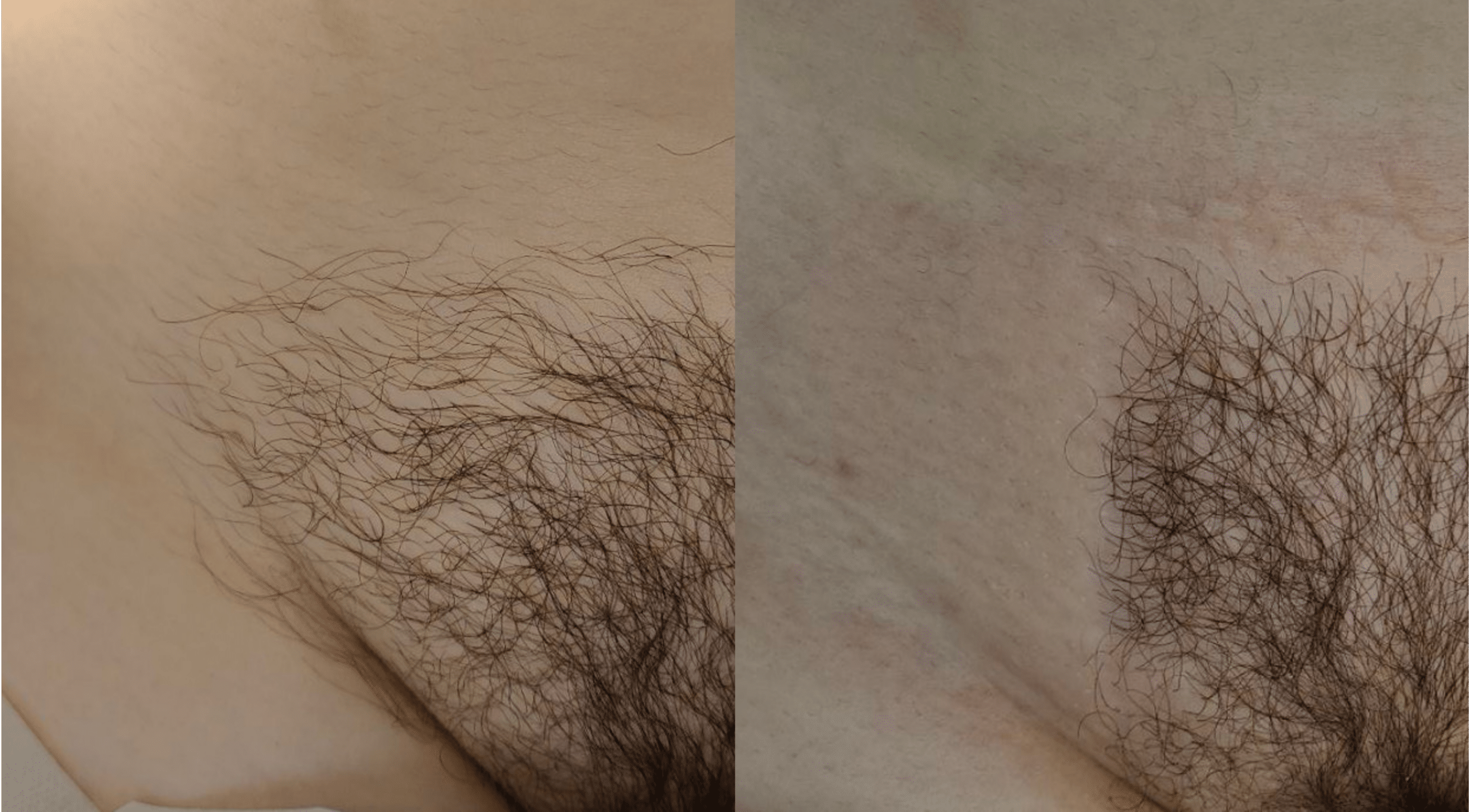 laser-hair-removal-paris-before-after