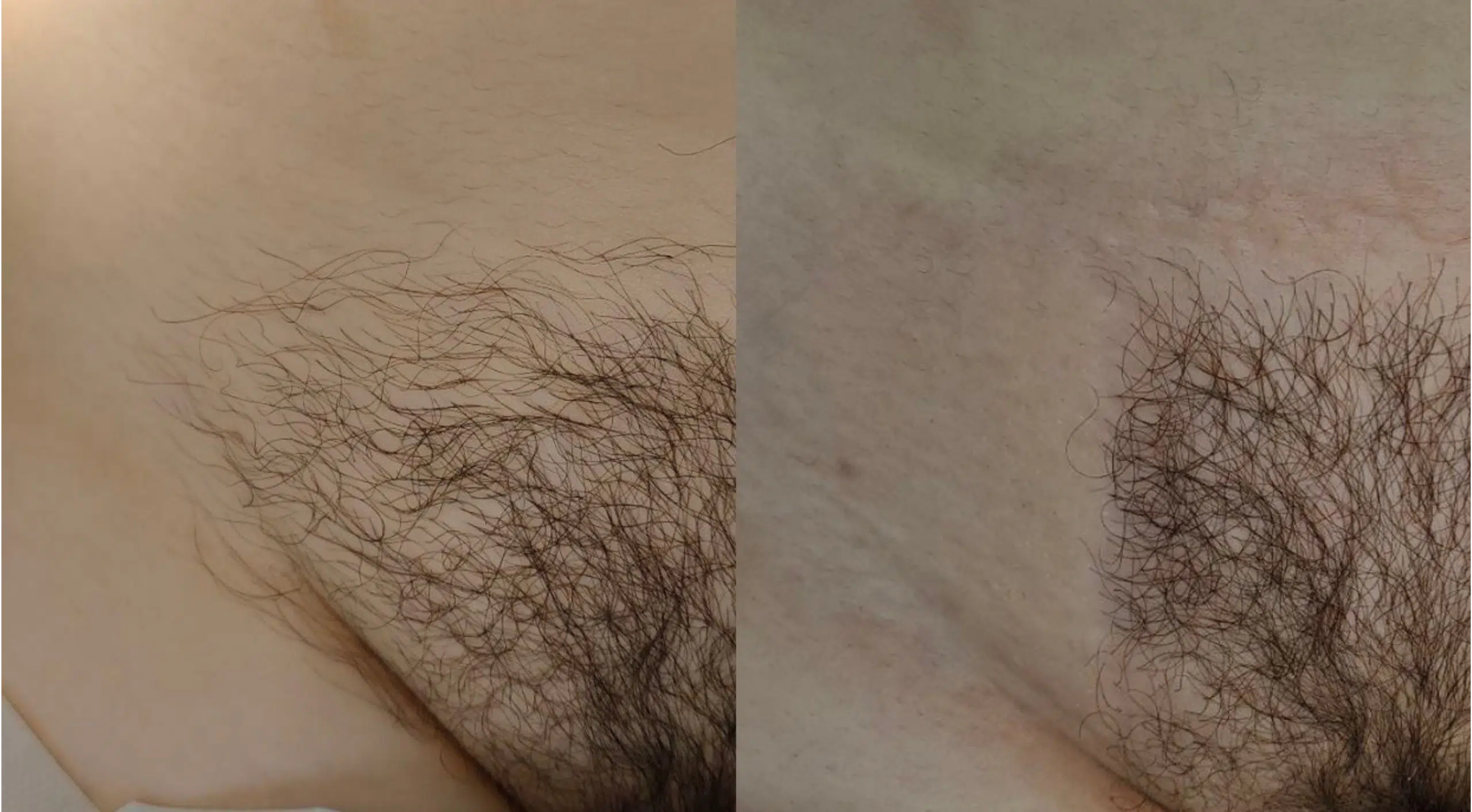 laser-hair-removal-paris-before-after