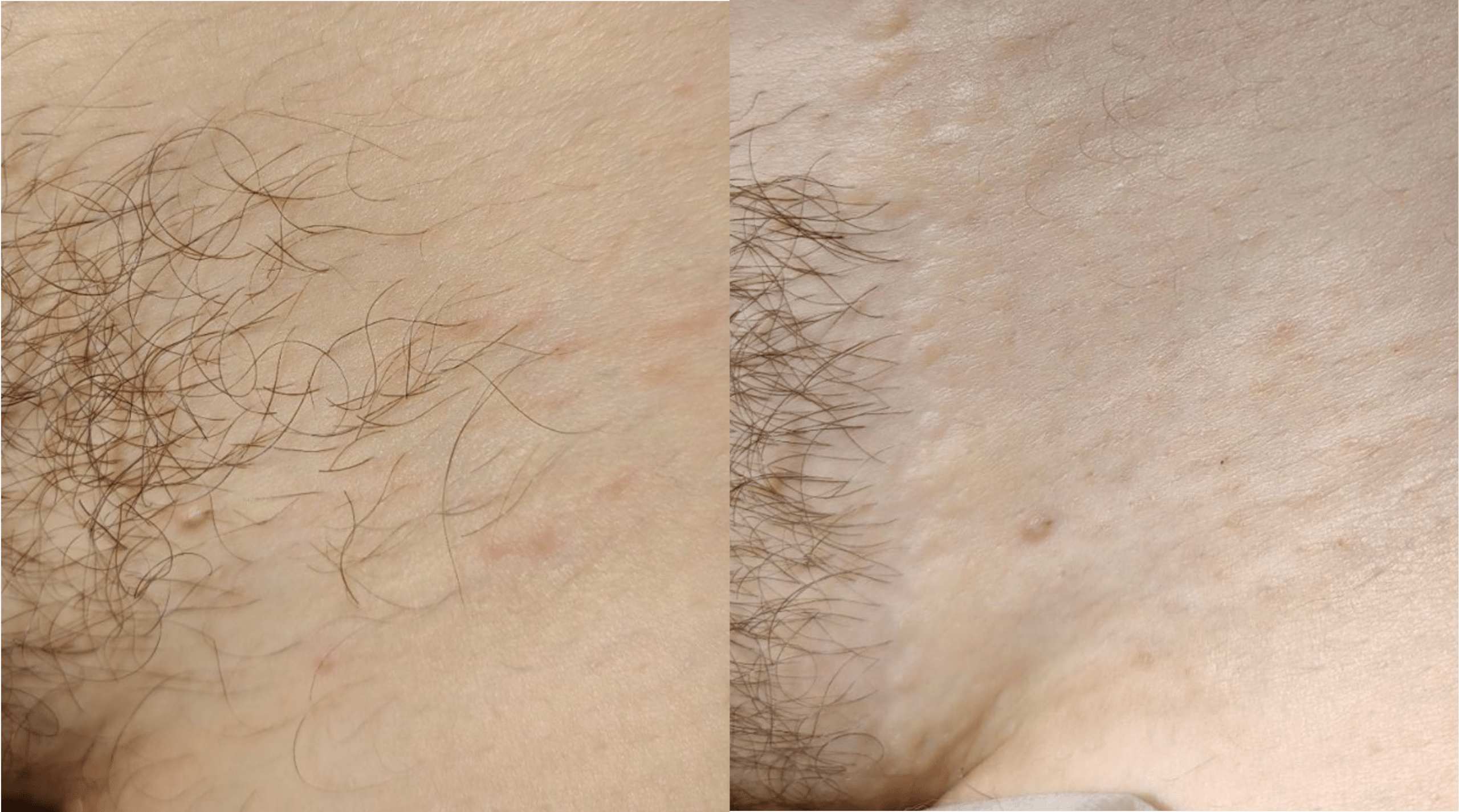 laser-hair-removal-paris-before-after