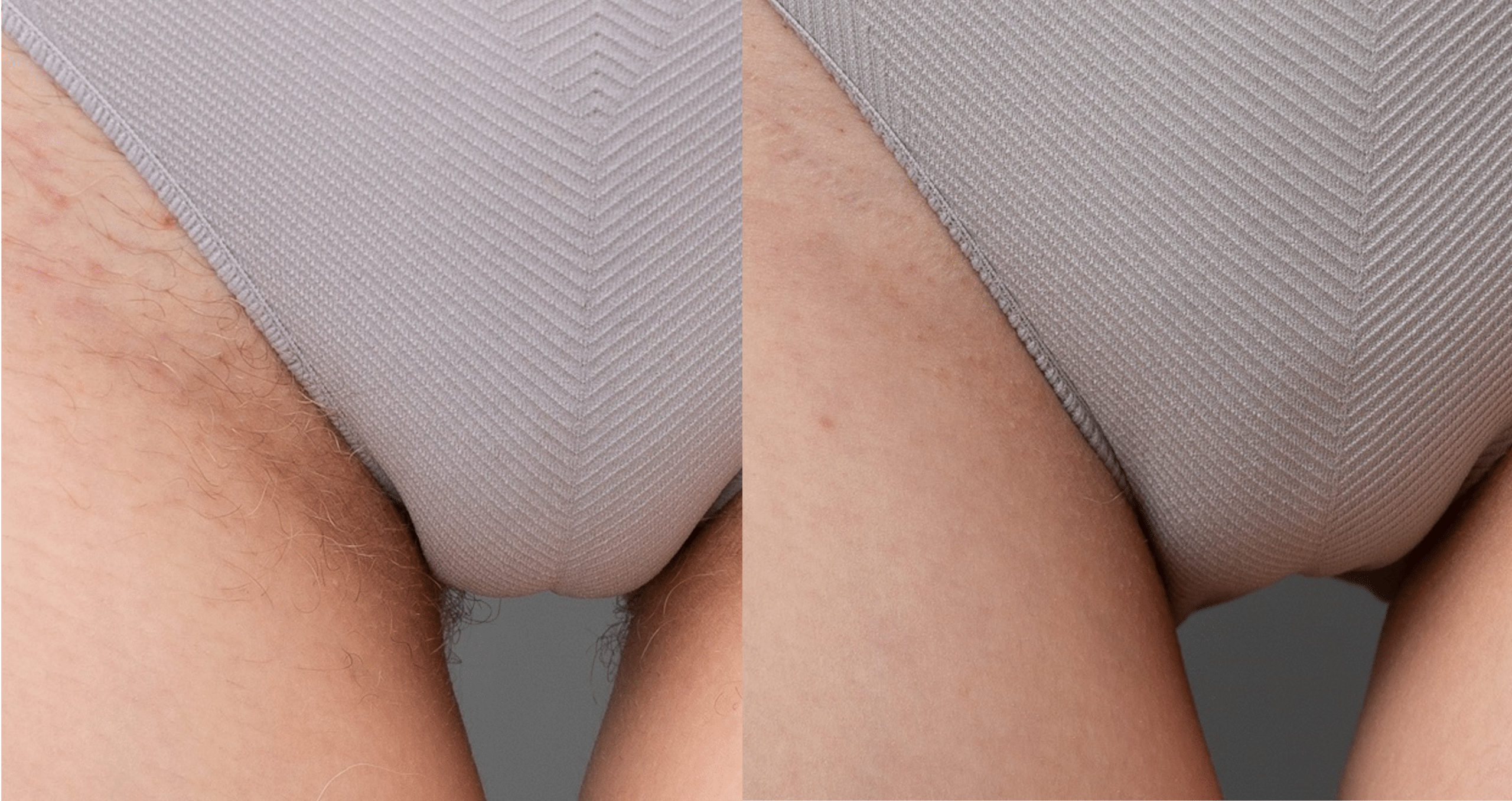 laser-hair-removal-paris-before-after