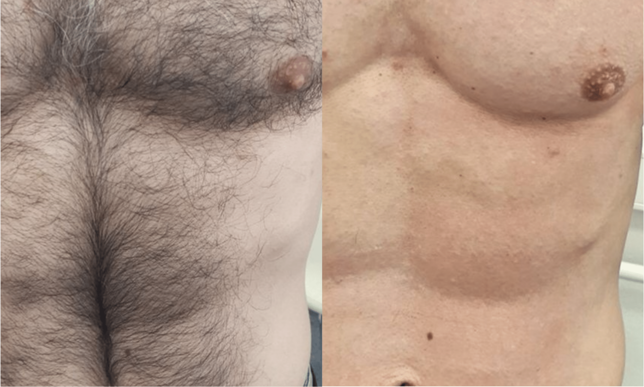 laser-hair-removal-paris-before-after