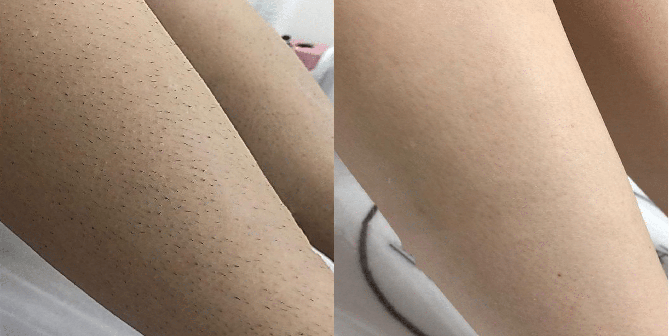 laser-hair-removal-paris-before-after