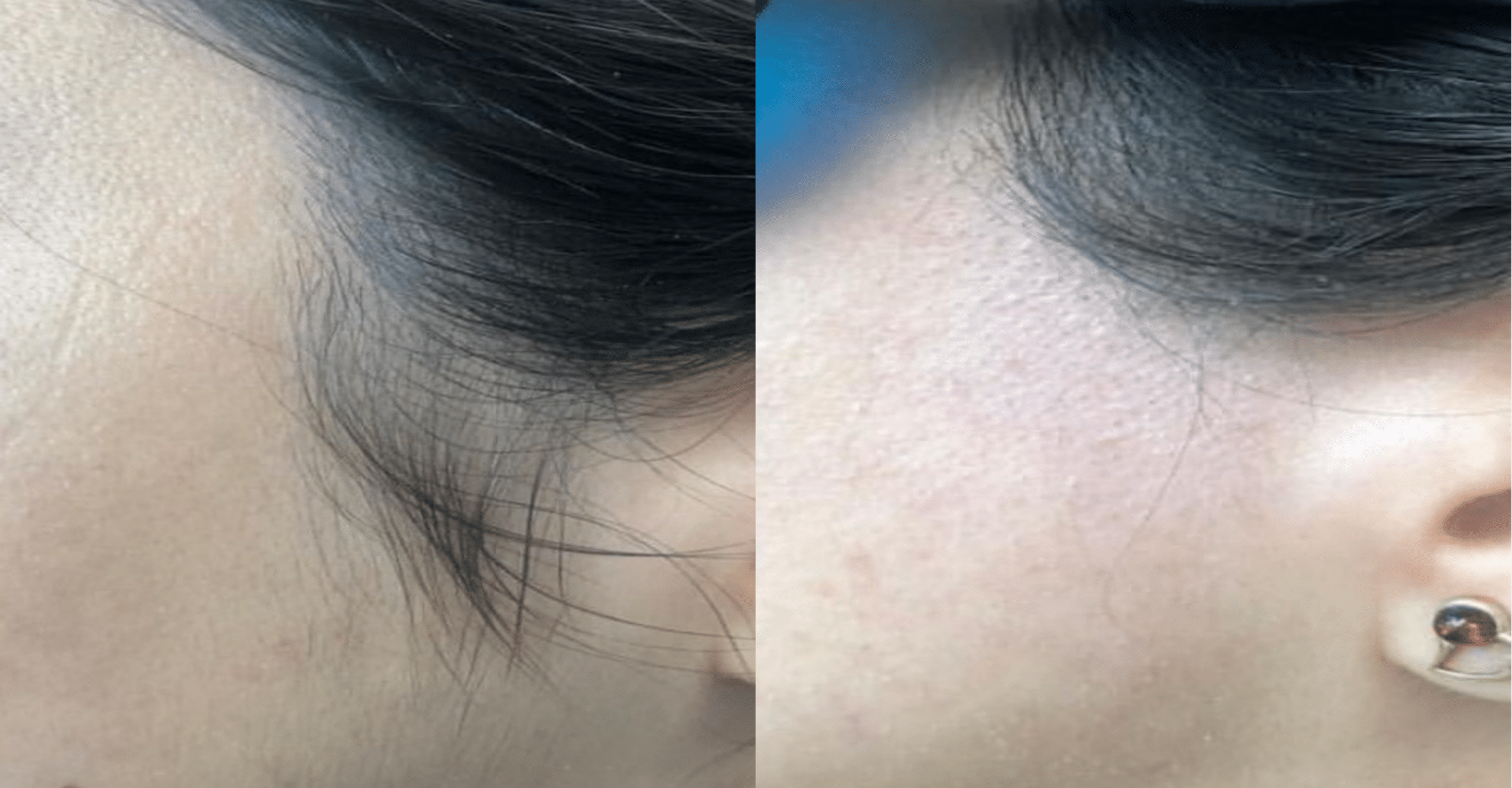 laser-hair-removal-paris-before-after