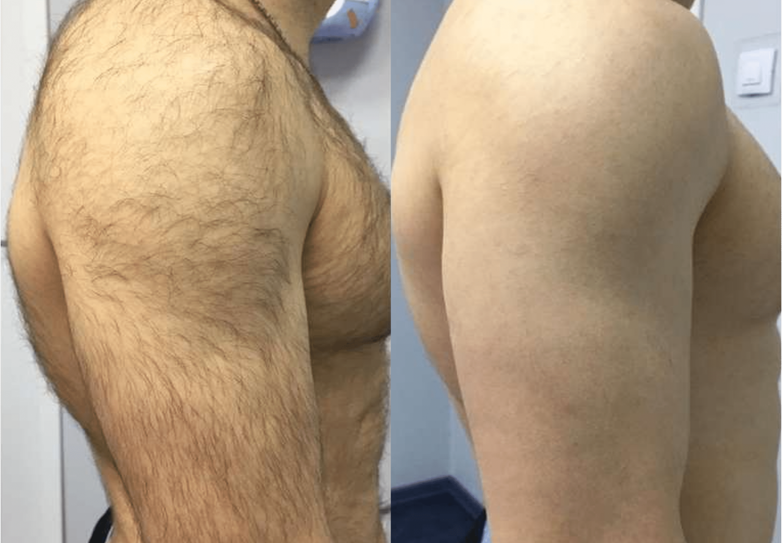 laser-hair-removal-paris-before-after