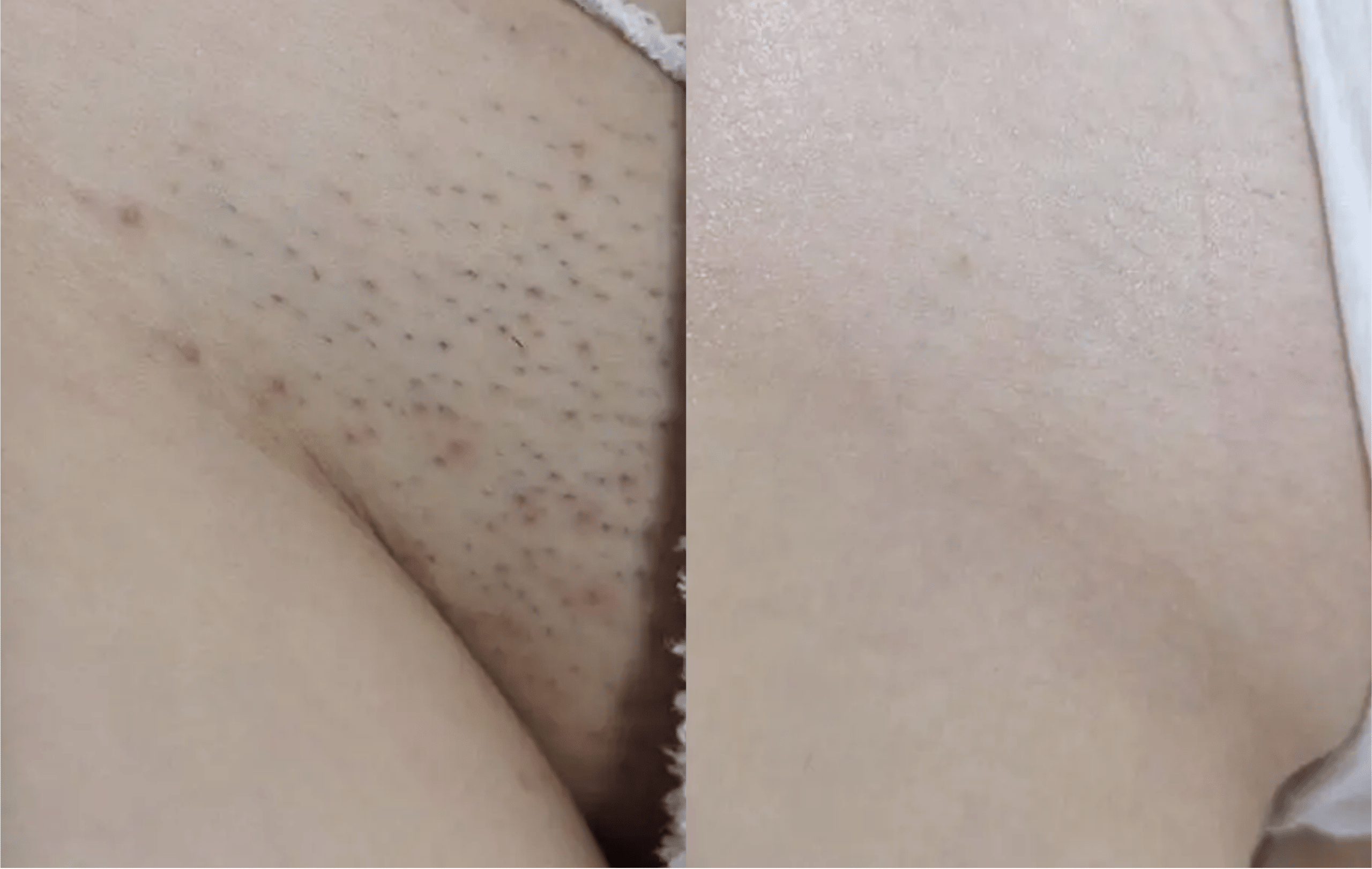 laser-hair-removal-paris-before-after