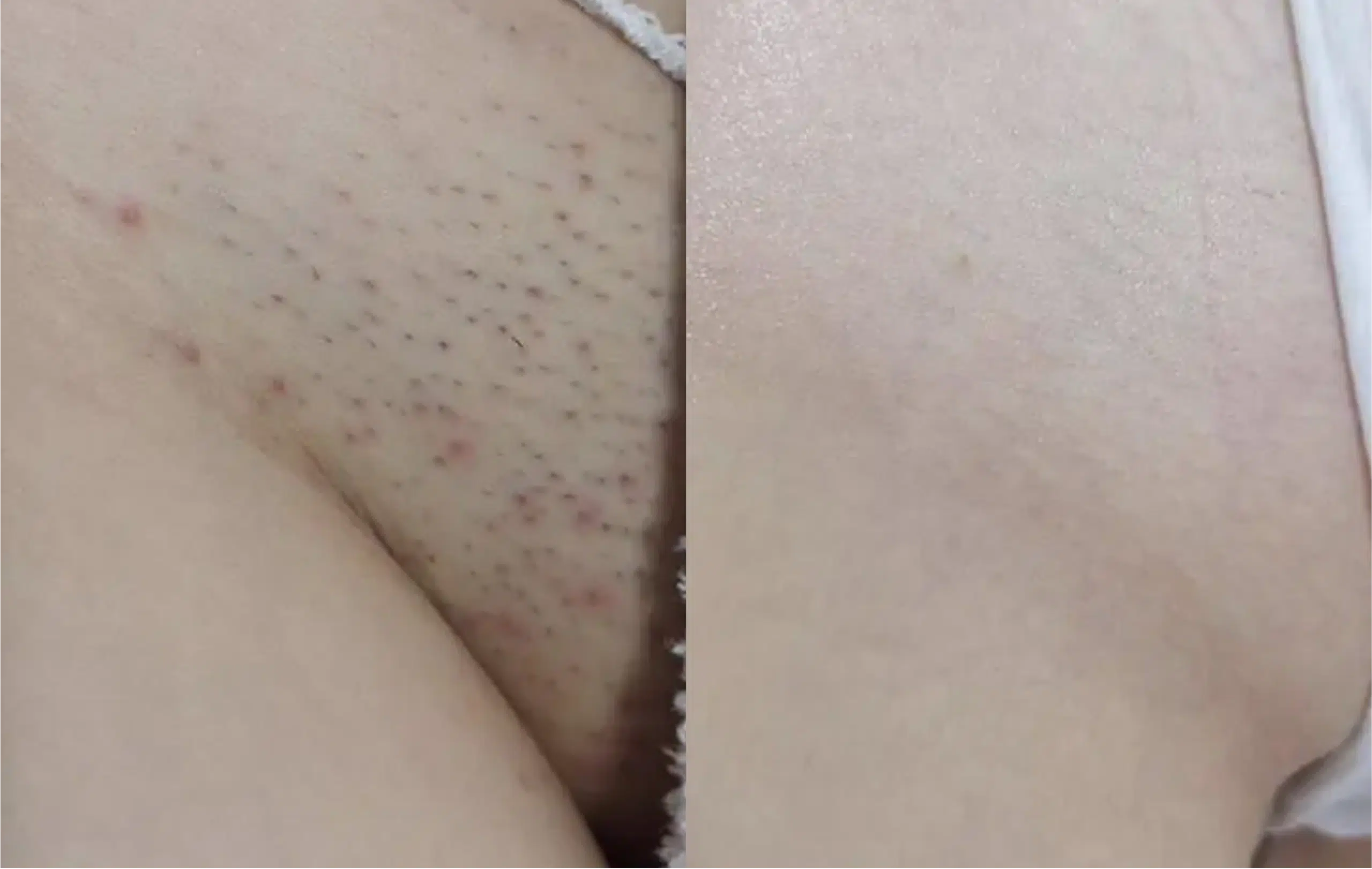 laser-hair-removal-paris-before-after