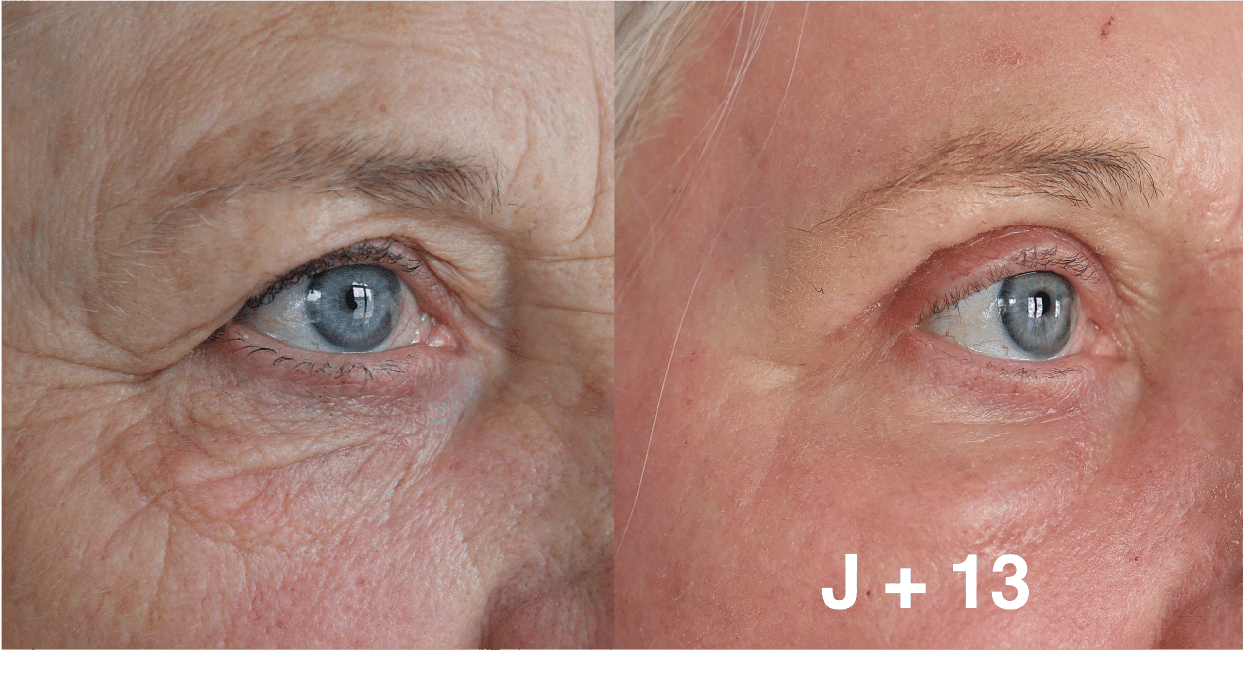 blépharoplastie laser avant apres results laser CO2 ultrapulse alpha