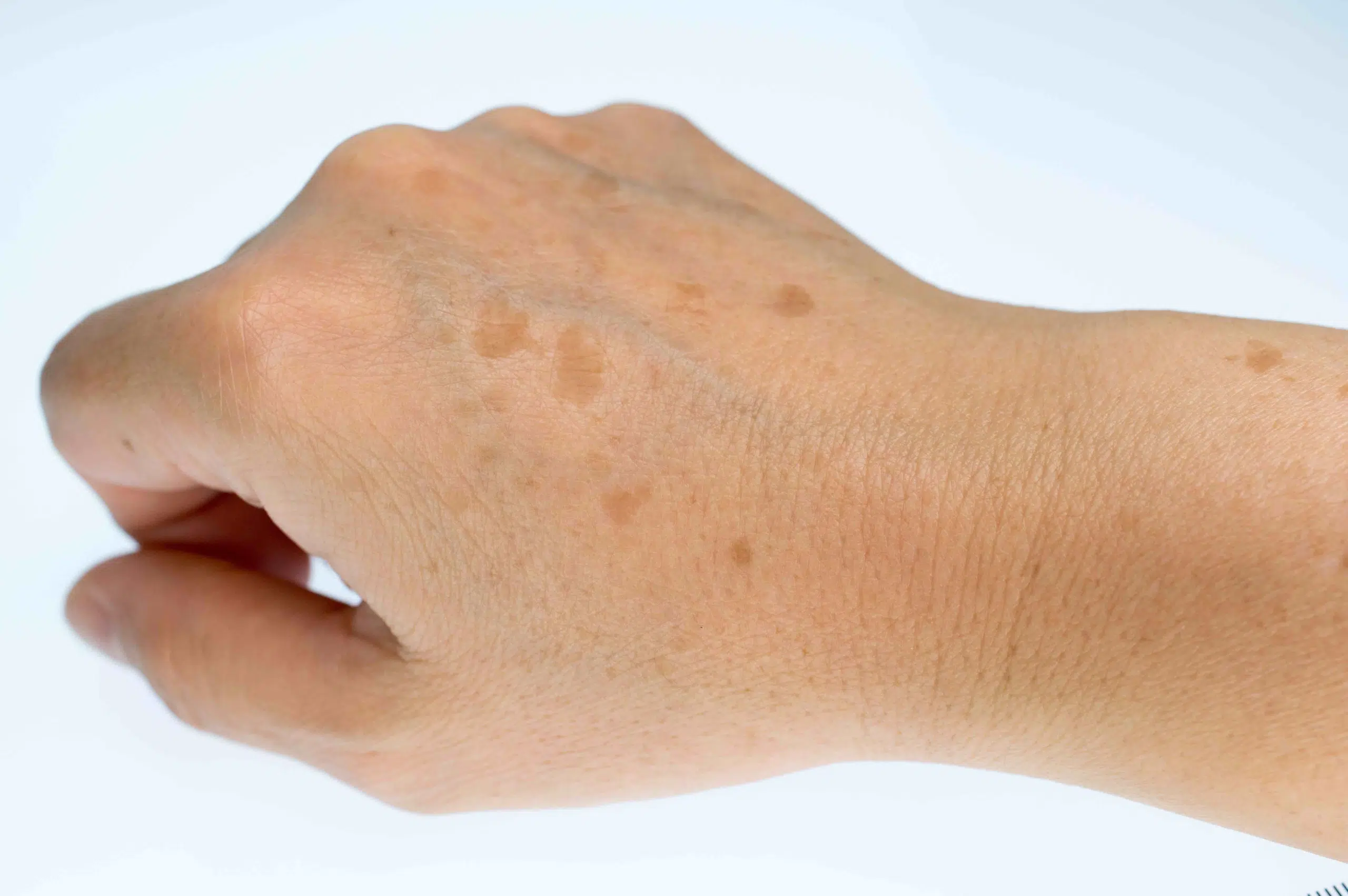 tache marron sur la peau photo 3