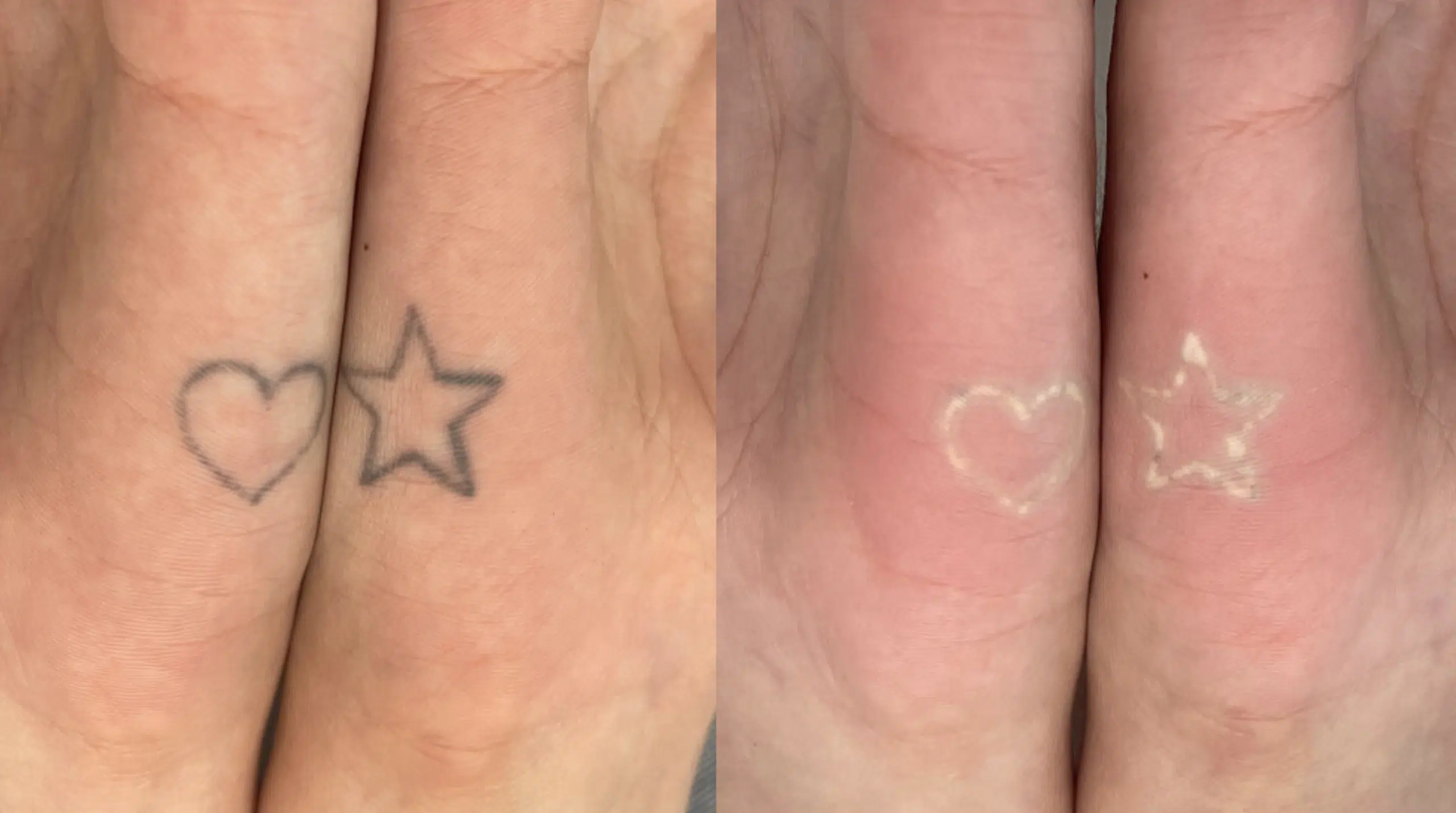 detatouage-apres-1-seance