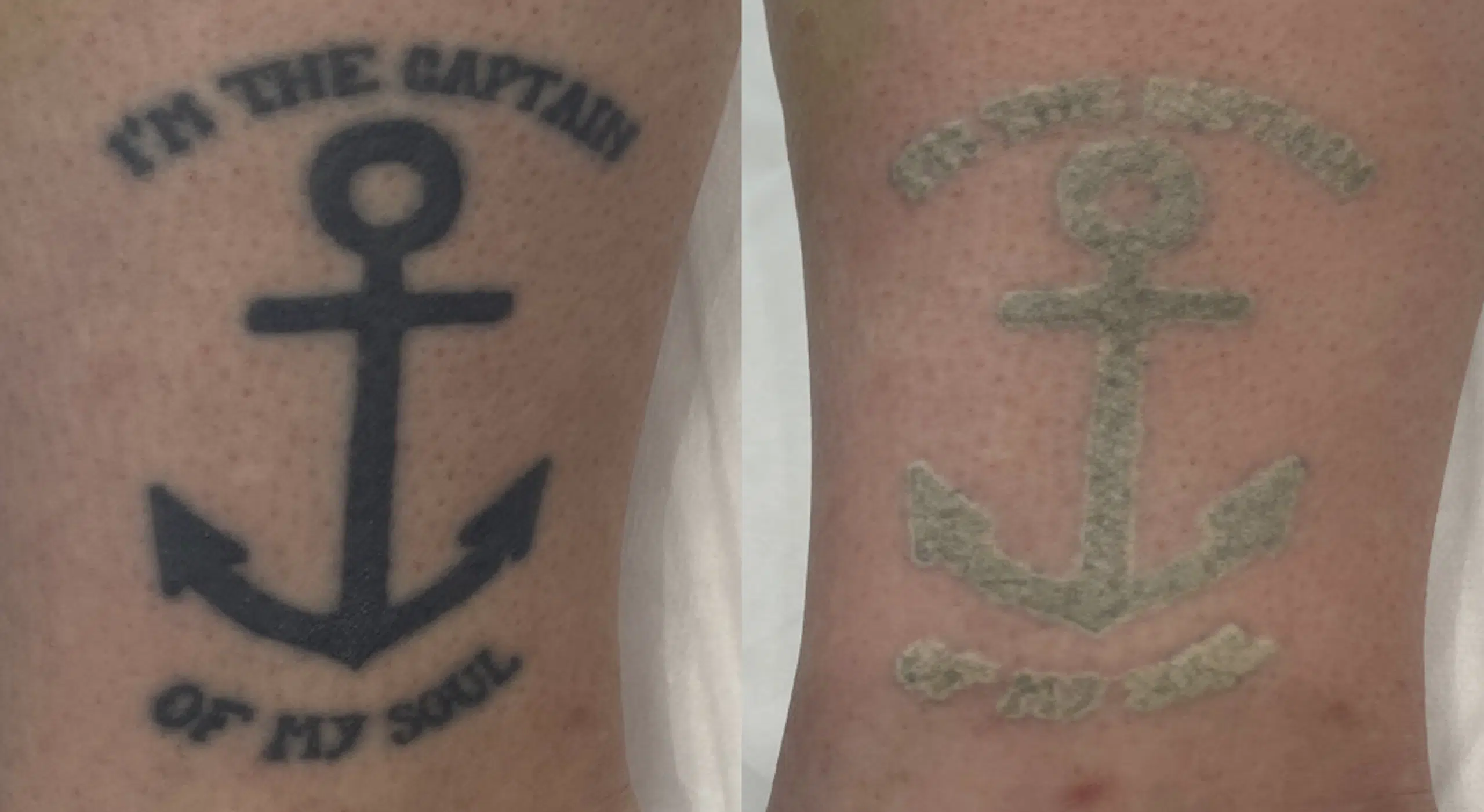 detatouage-avant-apres