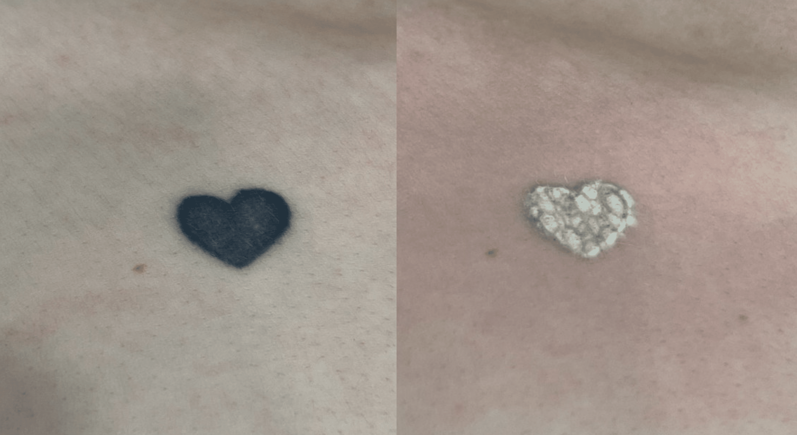 detatouage-apres-1-seance